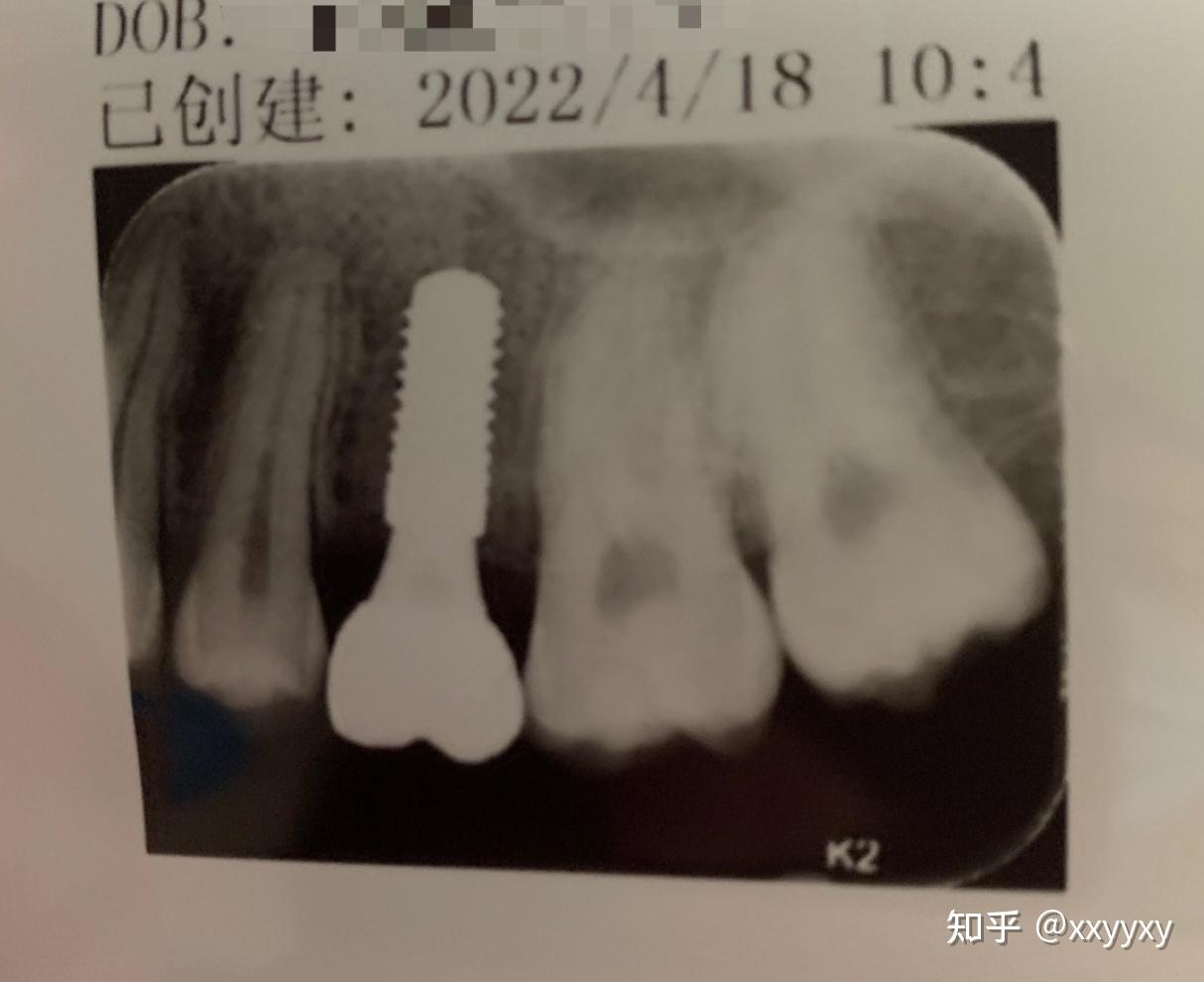 记北京口腔医院种植牙的过程及费用 - 知乎