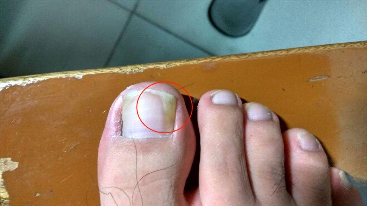 我脚趾甲右侧发黄变厚是灰指甲吗