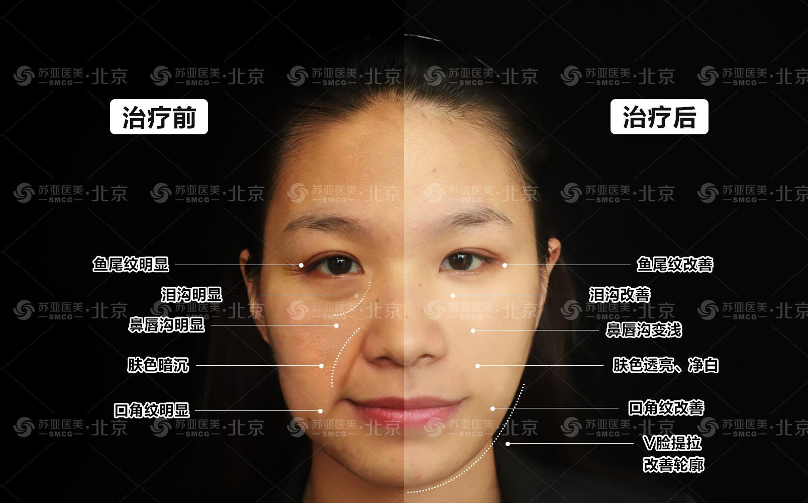 45岁以后在北京做了面部提升，术后实拍，真的年轻了 - 知乎
