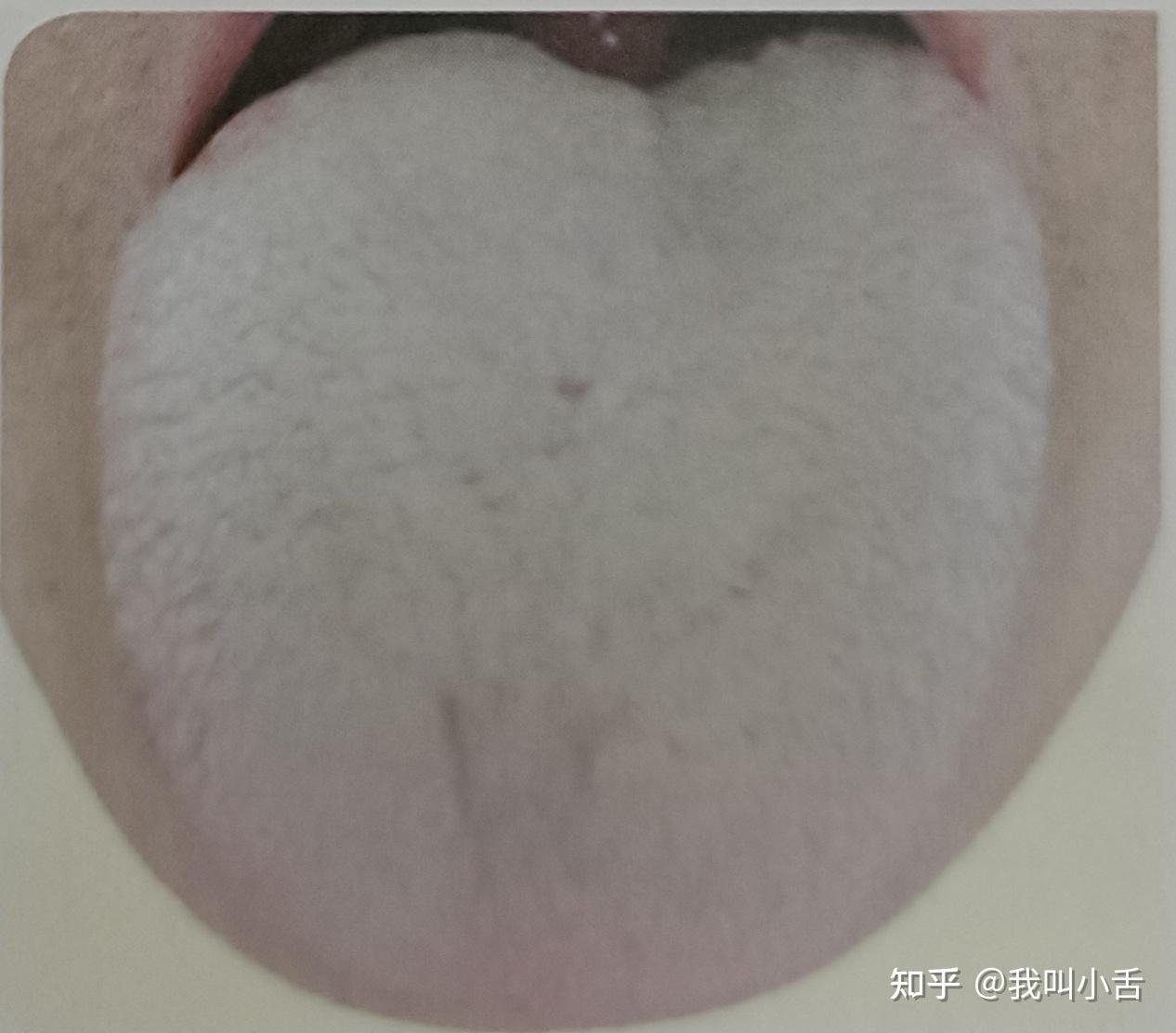 舌苔是如何形成的？白苔长什么样？如何判断自己的舌象呢？智能舌象助手来帮你！ - 知乎