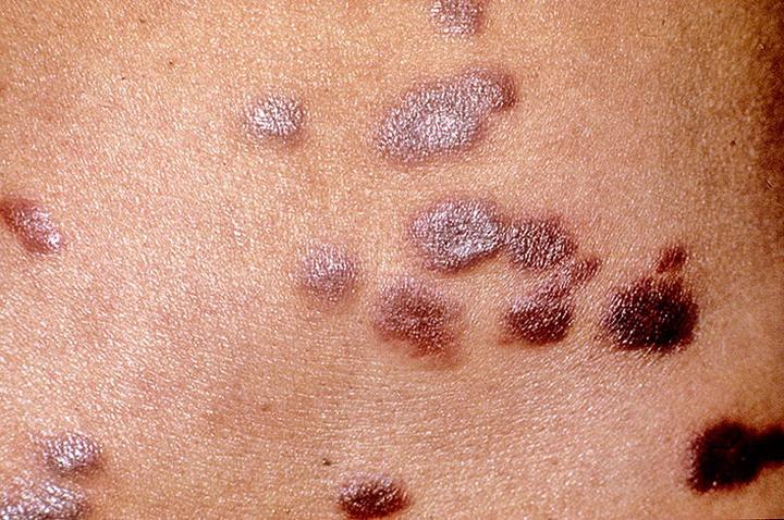 与尖锐湿疣易混淆的外阴疾病鲍温样丘疹病