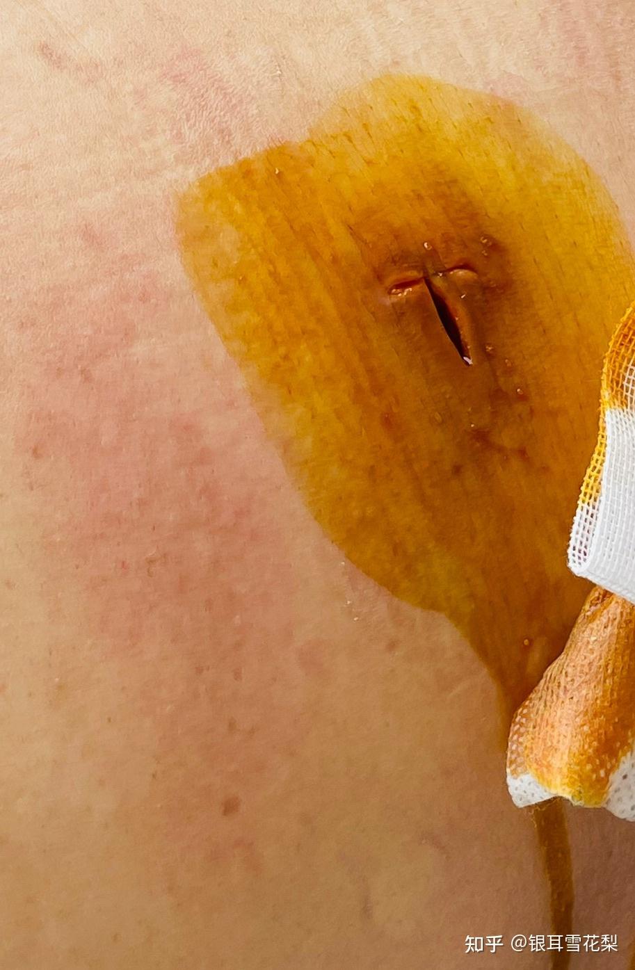 阑尾炎微创手术几天可以出院? - 知乎