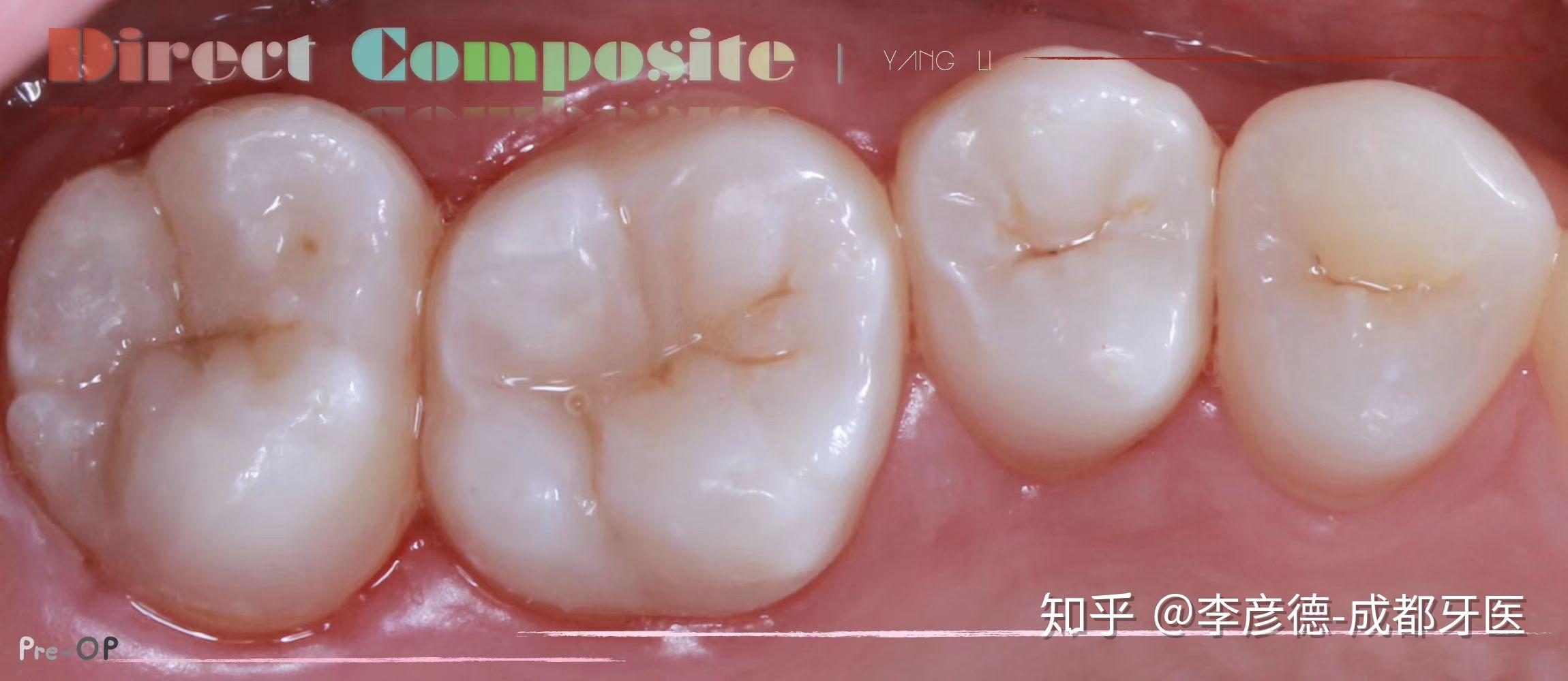 请问后槽牙补牙需要用美学材料吗