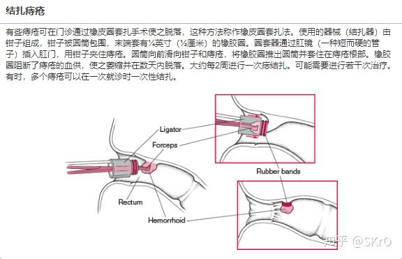 人为什么会得痔疮