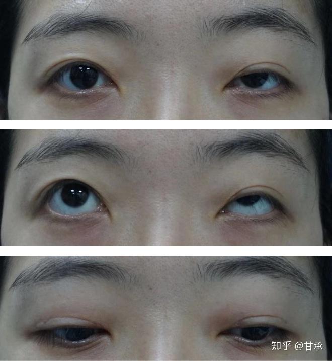 有做过上睑下垂手术的吗你有哪些手术经验分享