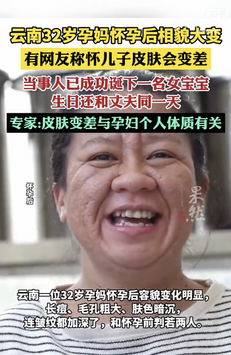 云南一孕妈怀孕后容貌大变，都说怀儿子皮肤会变差、女孩会变好，真是这样吗？孕后皮肤状态与哪些因素有关？