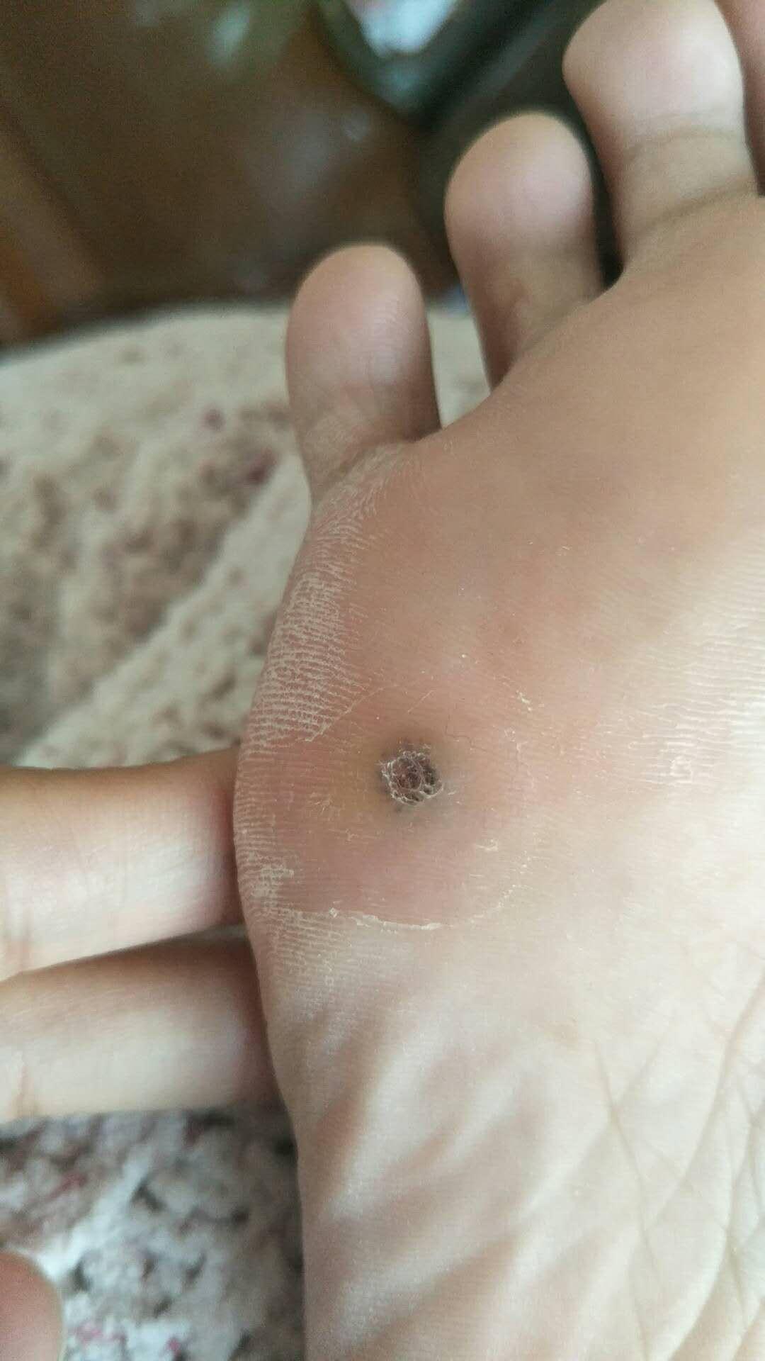 脚上长病毒疣怎么治? - 知乎