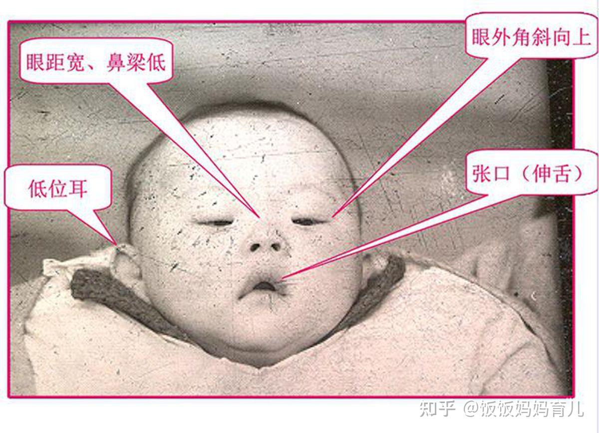 为何“唐氏宝宝”普遍长得很“相似”？背后的真实原因令父母落泪-搜狐大视野-搜狐新闻