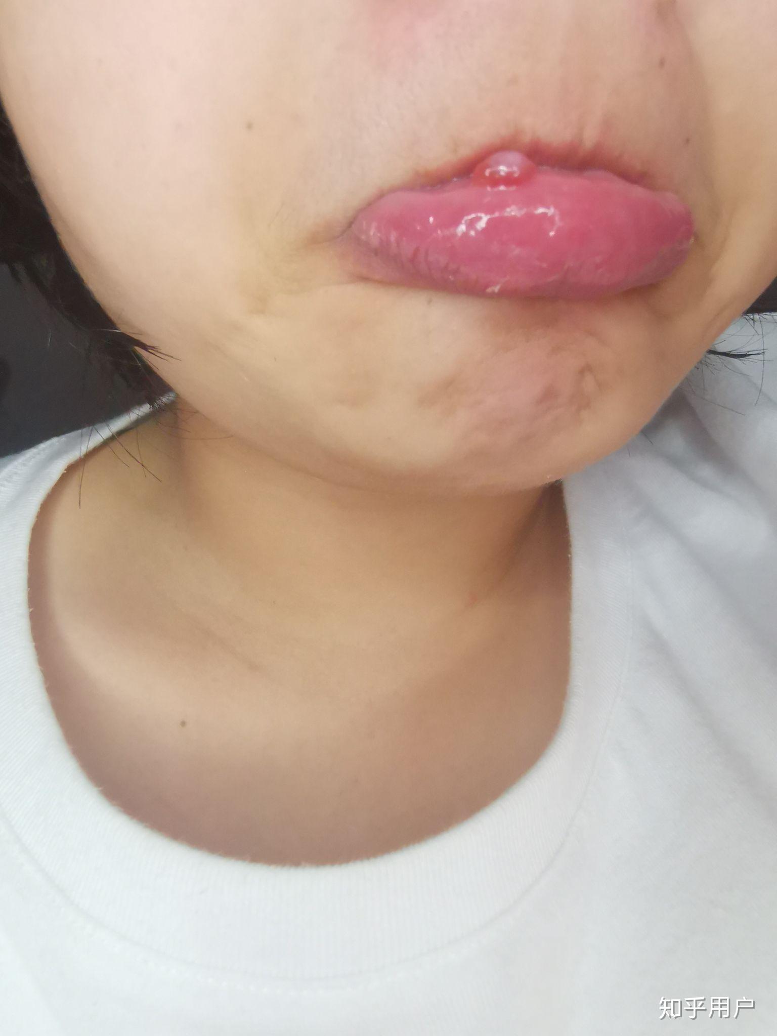 嘴唇粘液腺囊肿手术后 知乎
