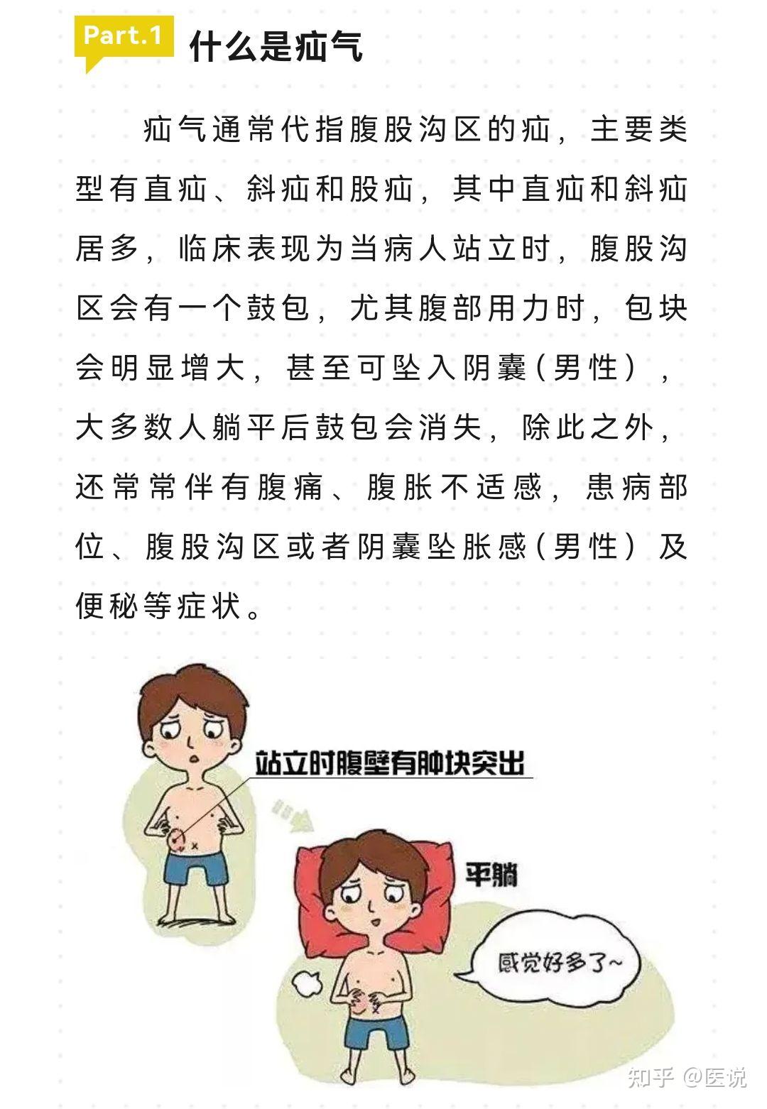 疝气有哪些常见的类型?