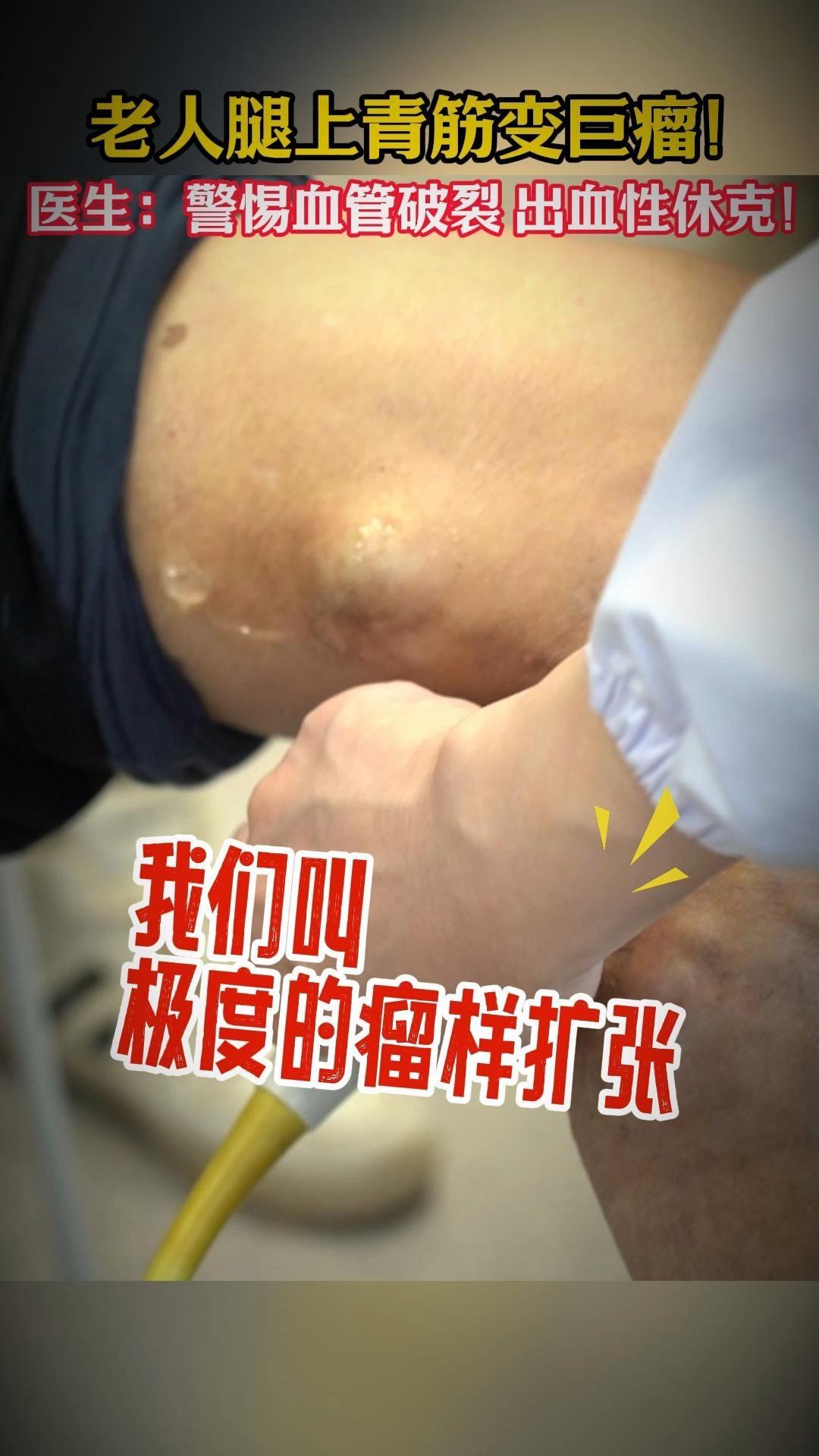 老人腿上静脉曲张长出巨大血管瘤医生提醒警惕破裂出血风险