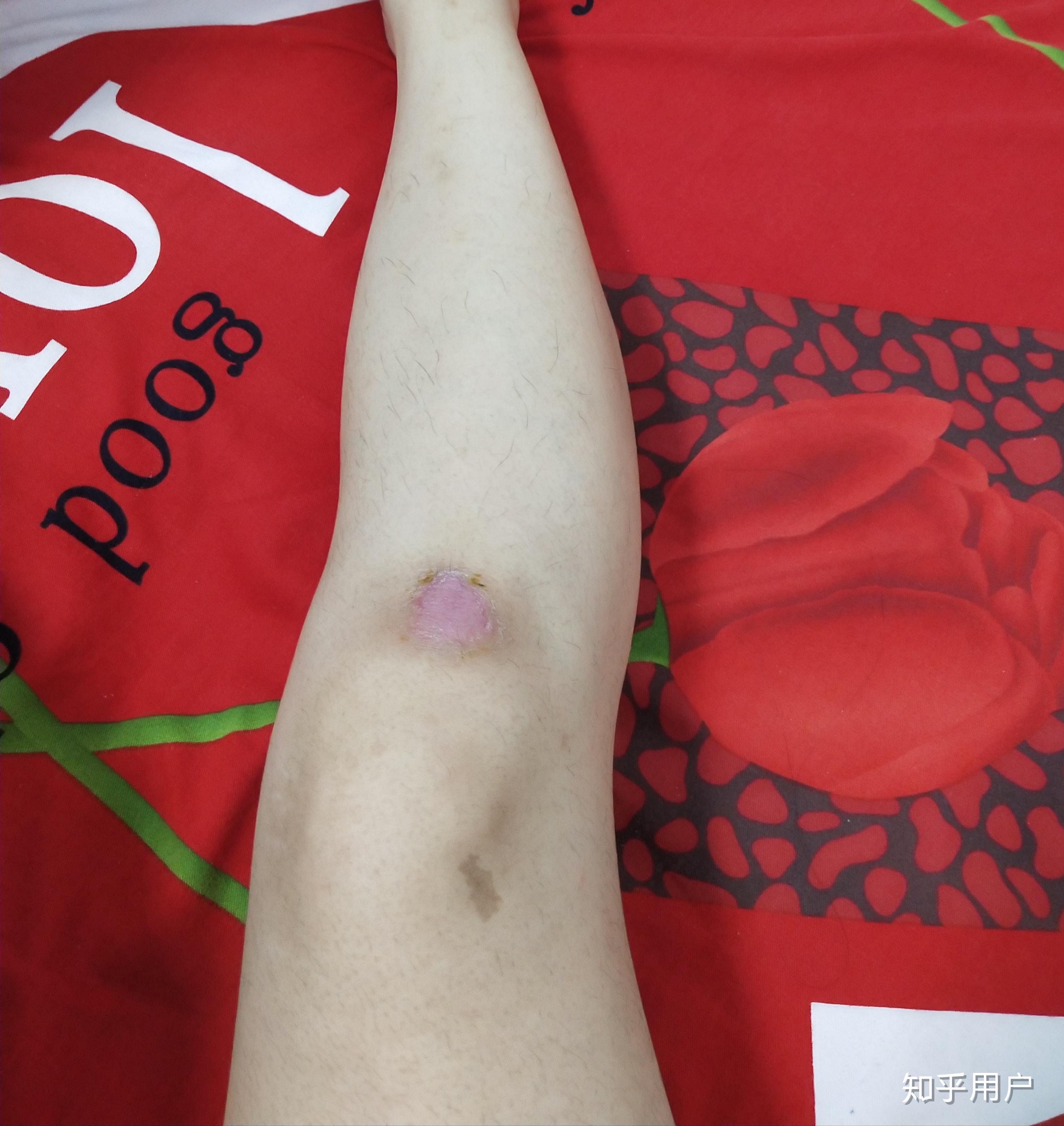 骑车侧翻膝盖摔伤破皮怎么处理伤口怎样才能不留疤