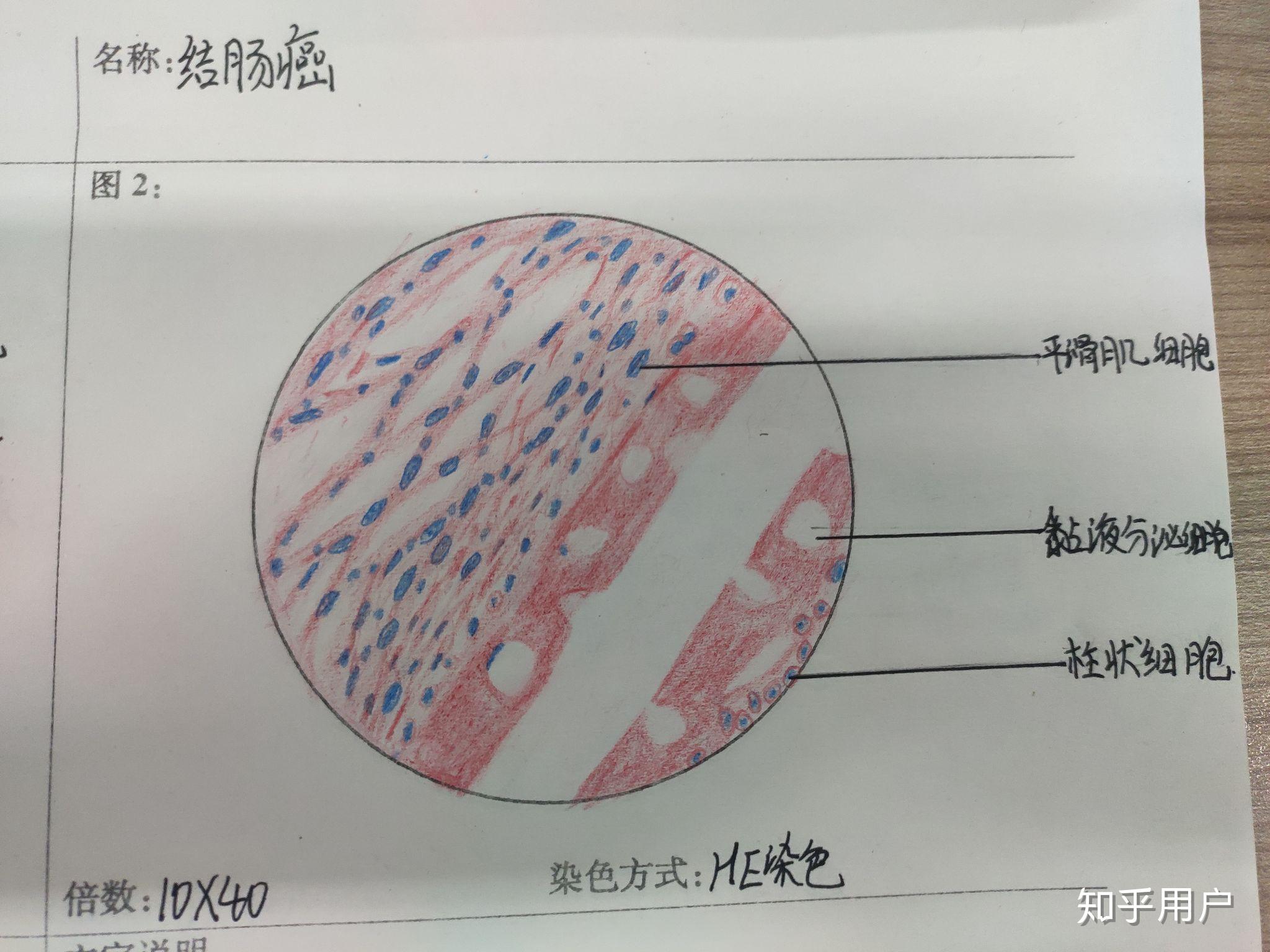 有没有人有病理的结肠腺癌红蓝铅笔手绘图啊? 