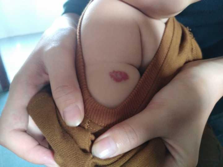 静脉血管瘤的临床表现