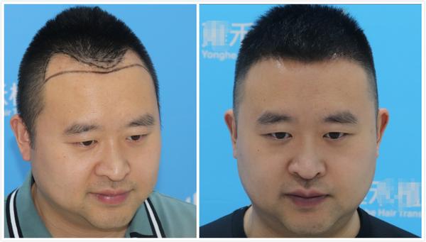 发际线后移是可逆的!