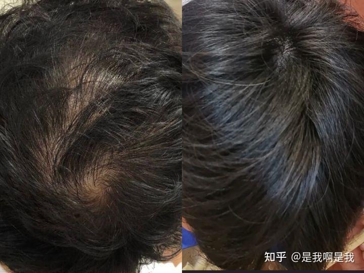 从“地中海”变身“发量王者”,全靠中科院博士推荐的防脱育发液,实测30天发量翻倍,改善狂掉发、头顶秃! - 知乎