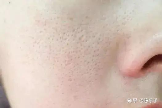 长年皮肤干一洗完脸干了就起皮该怎么补水和保湿