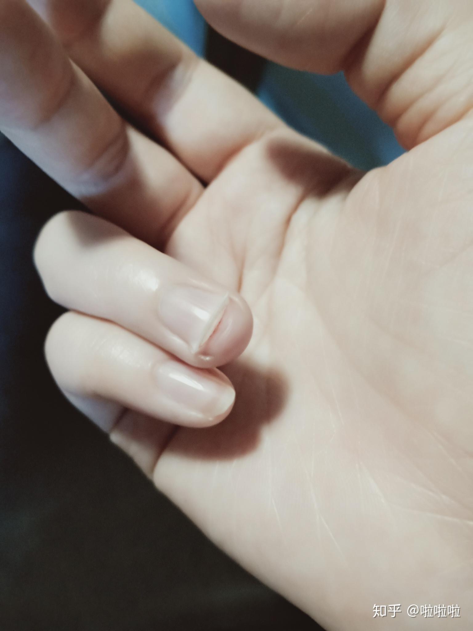手指甲边上长了很硬的死皮，剪掉了还会长出来，如图，请问这种在医学上叫什么？如何处理