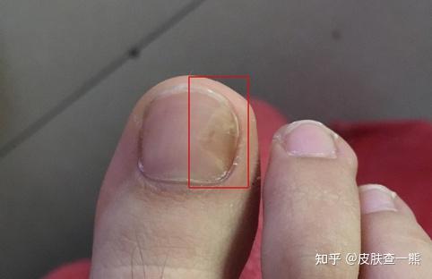 脚趾甲好像有一片空了这是怎么回事啊