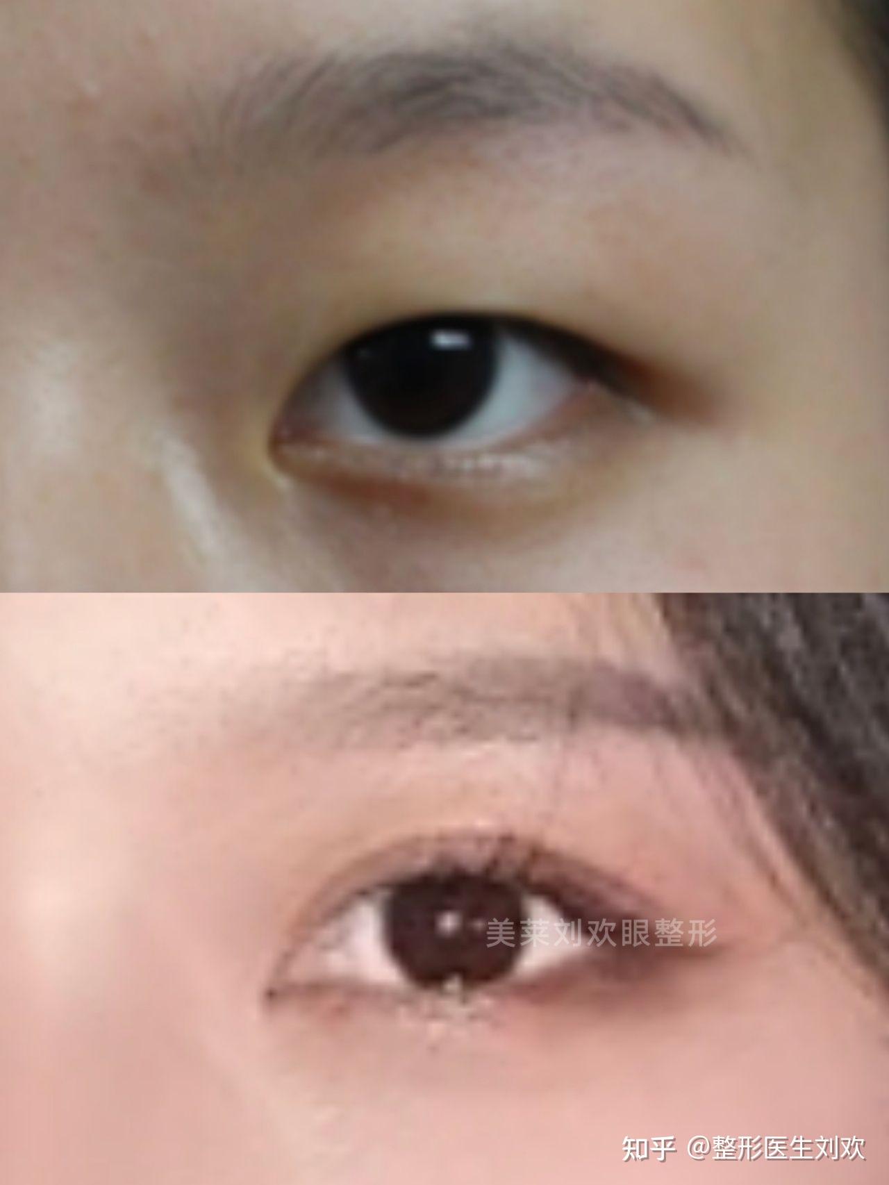 简单介绍下park法重睑术—双眼皮推荐术式 - 知乎