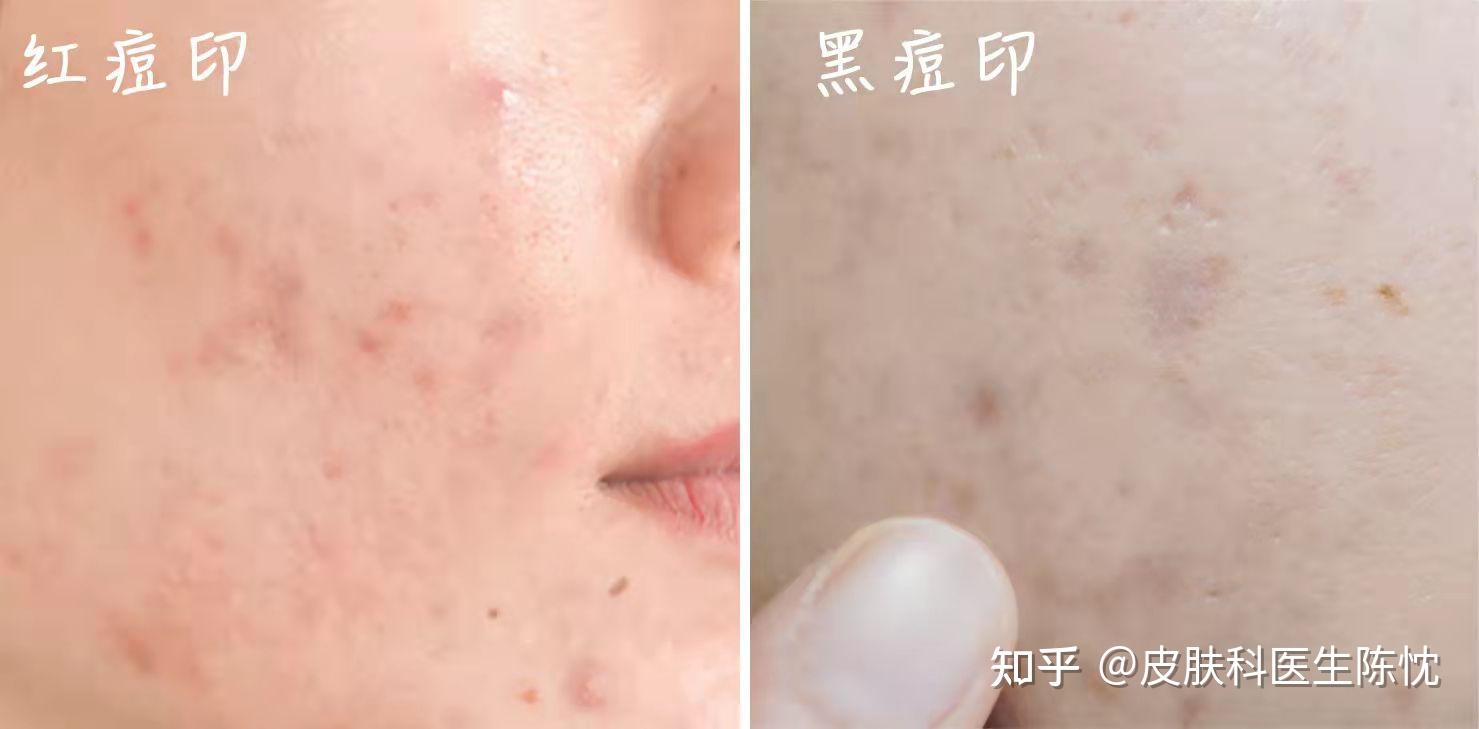 红色痘印与黑色痘印该怎么管理？ - 知乎