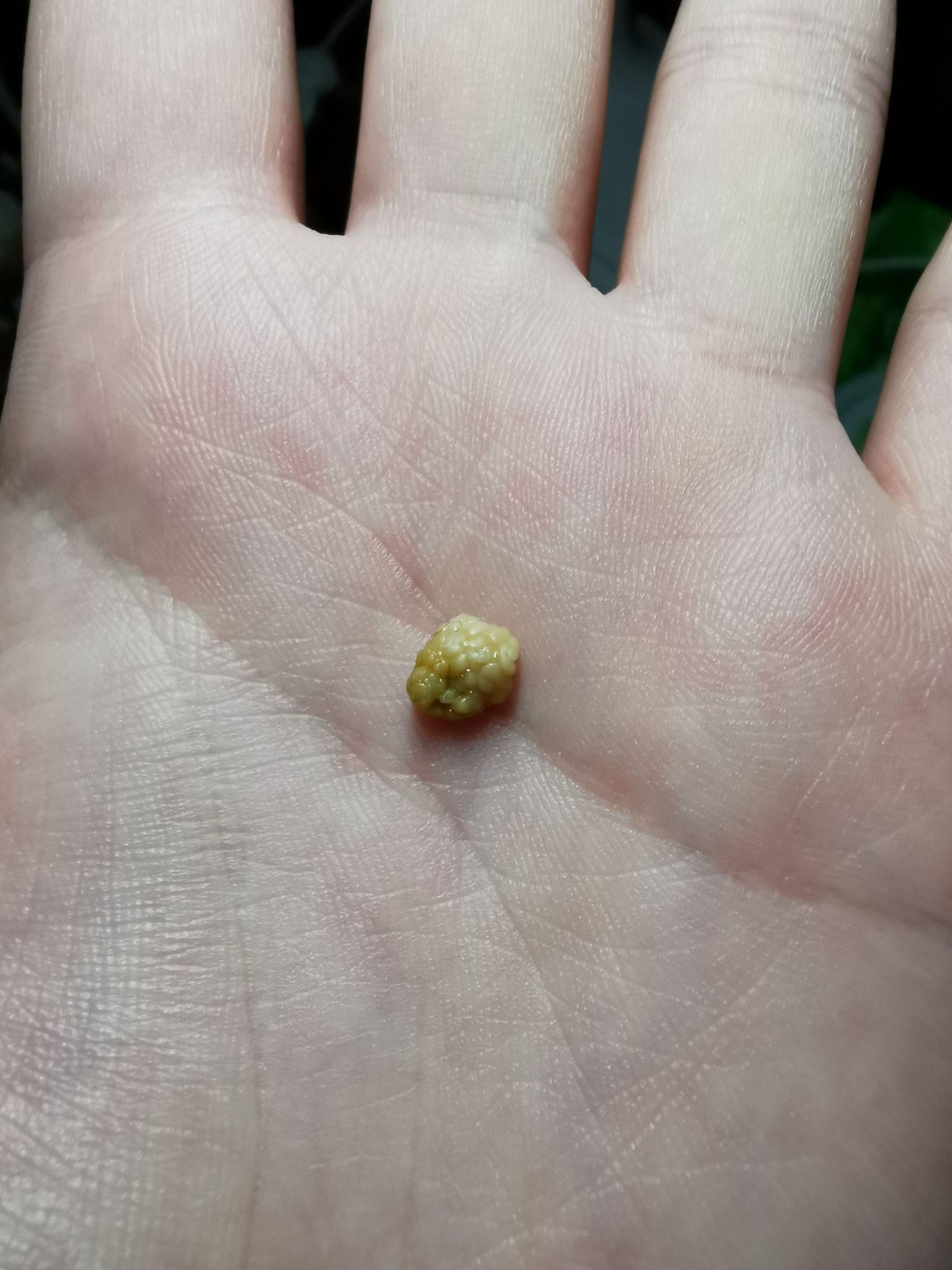 你见过最大的扁桃体结石有多大