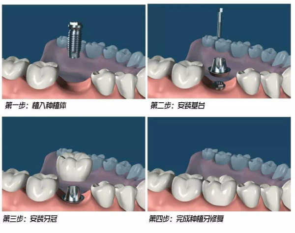 初中时被撞掉牙齿成年后还能索赔修复费用吗？