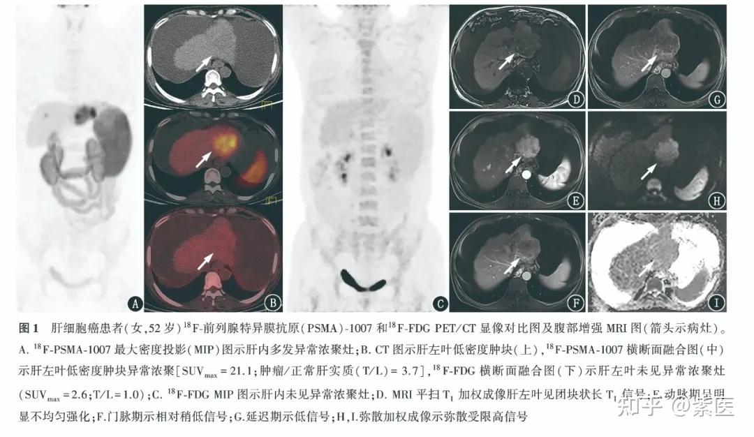 18F-PSMA-1007与18F-FDG PET/CT在初诊肝细胞癌诊断中的应用比较 - 知乎