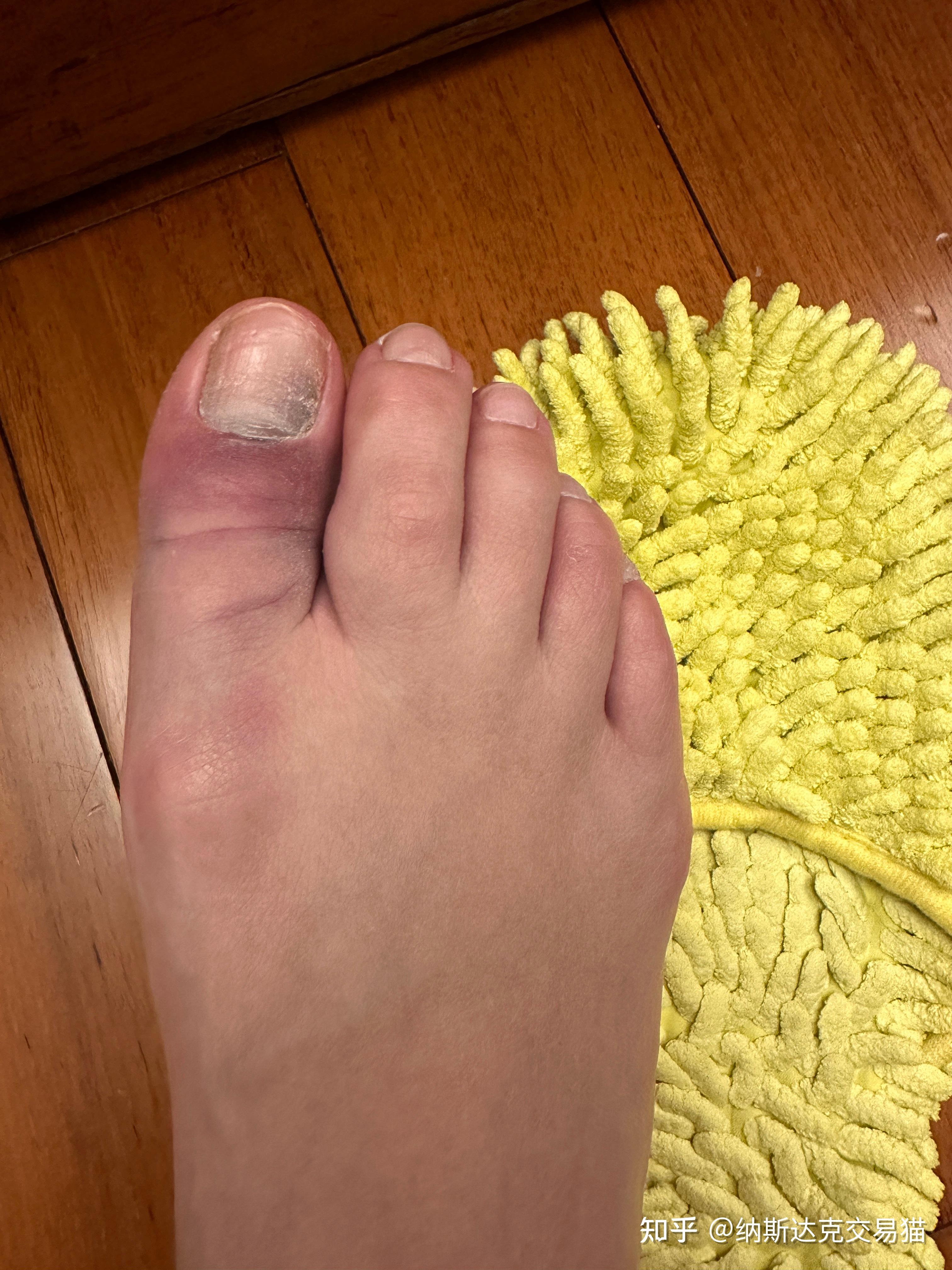 大拇脚趾头骨折 如何快速恢复?