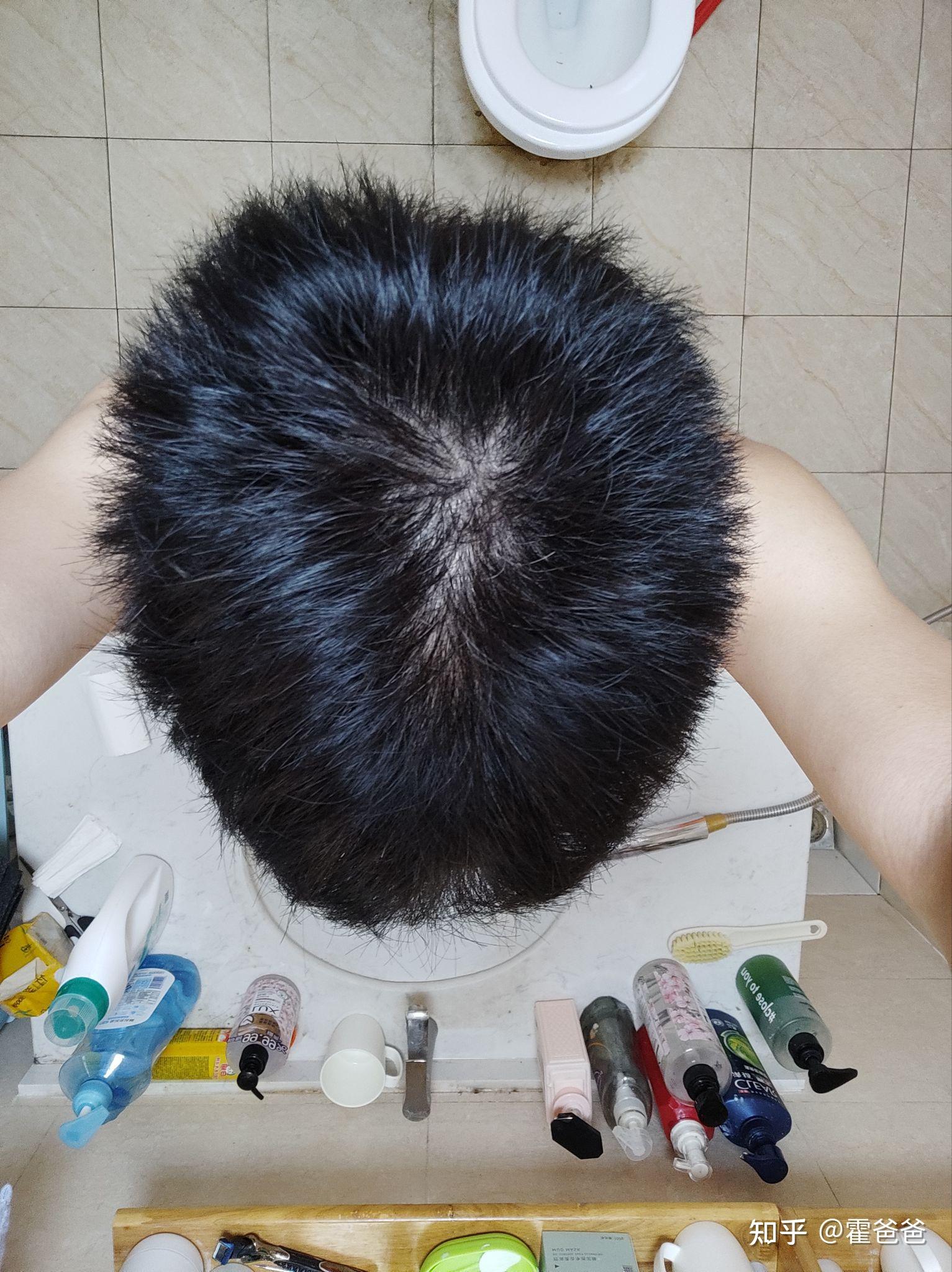 我这样的头顶正常吗见图