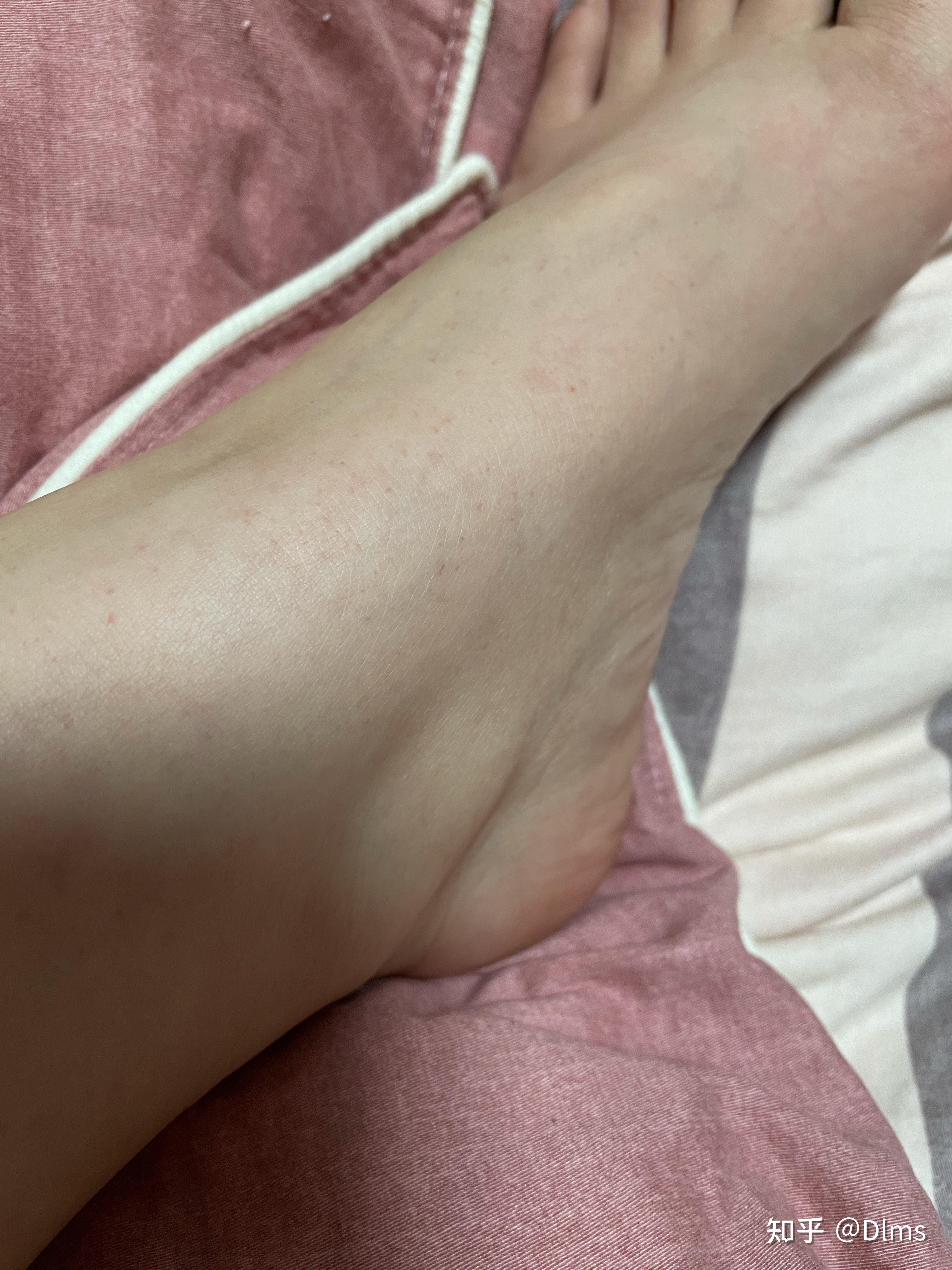脚踝皮肤下面长一个个的红点点…很少但是好像越来越多…这是什么?