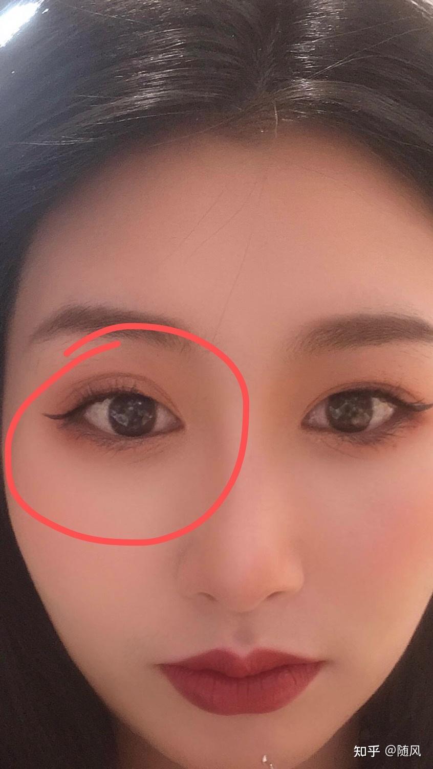 这个双眼皮割的是不是太窄了感觉眼睛也很没神