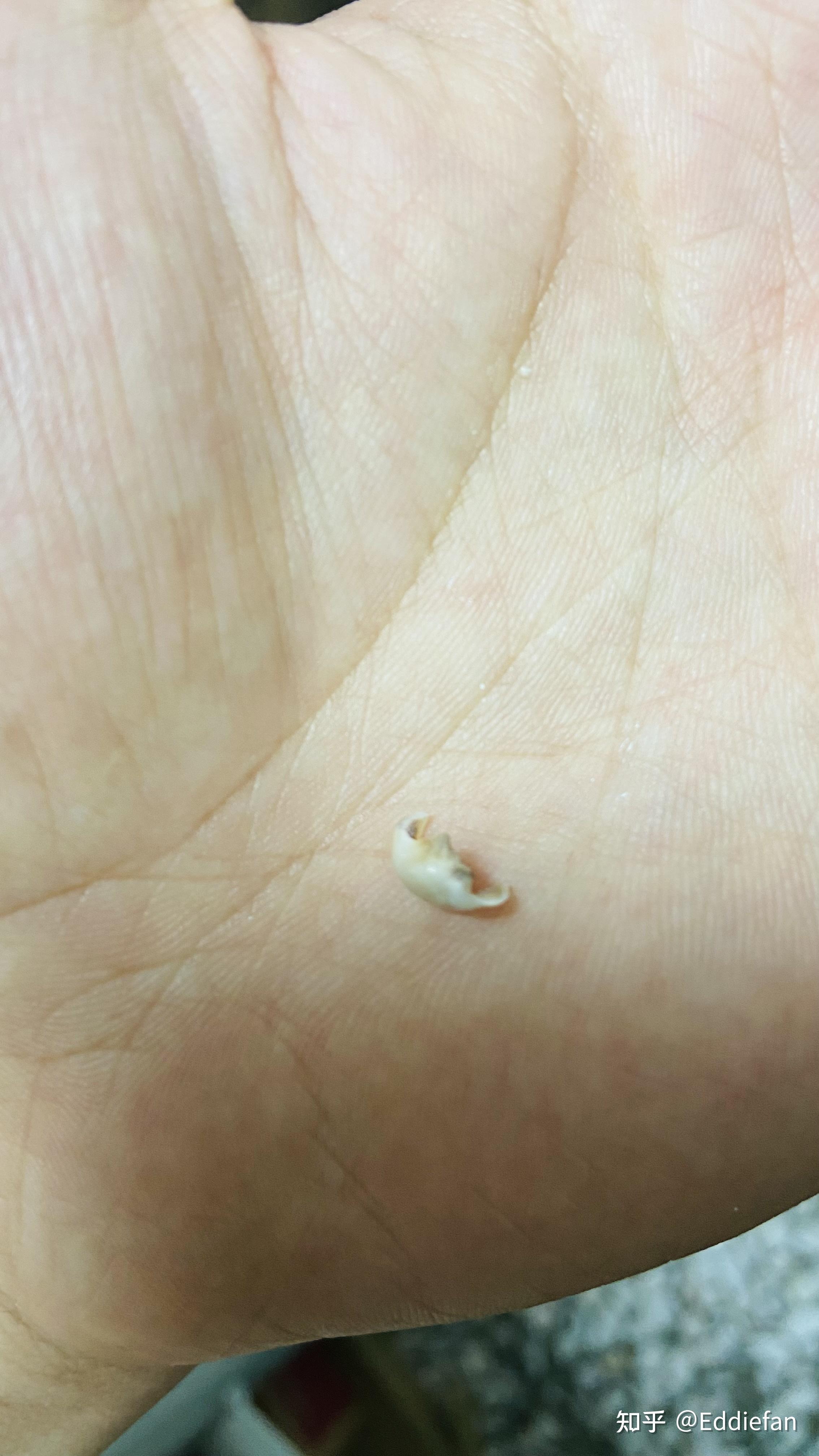 今天拔了智齿但是没有拔干净留了一块会不会以后和肉长到一起变严重