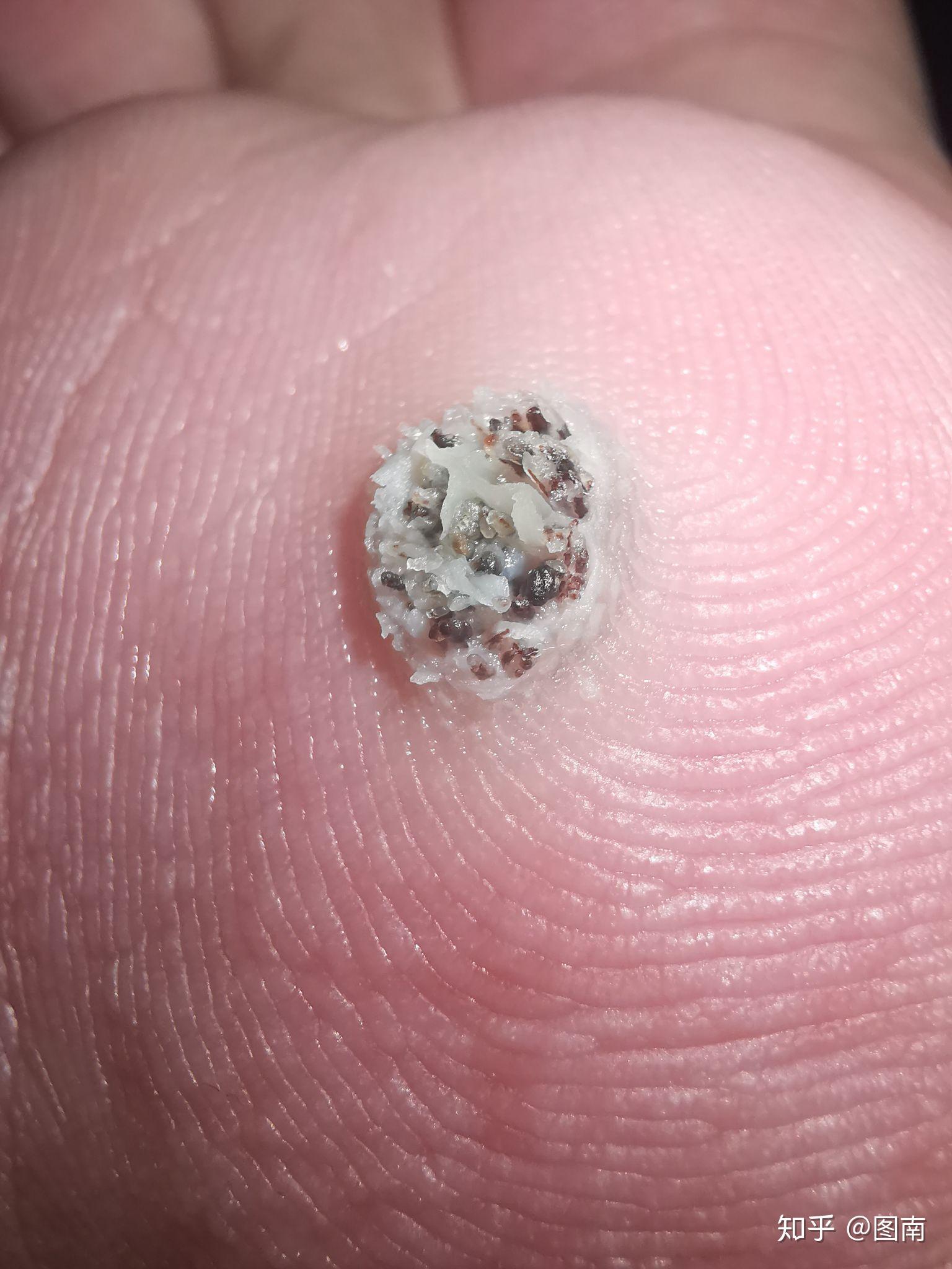 跖疣的自愈性大吗? - 知乎