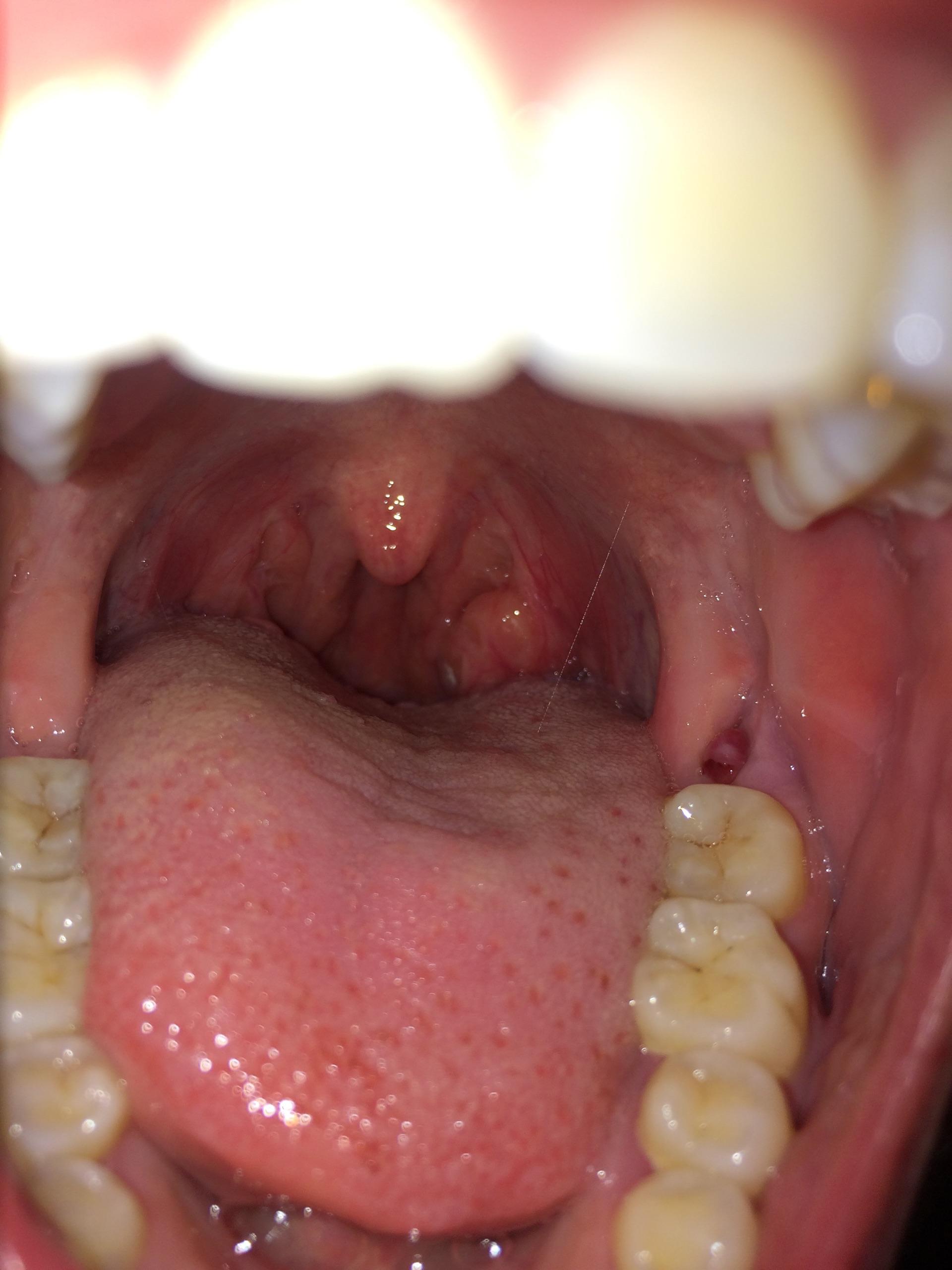 有说是扁桃体角化质的