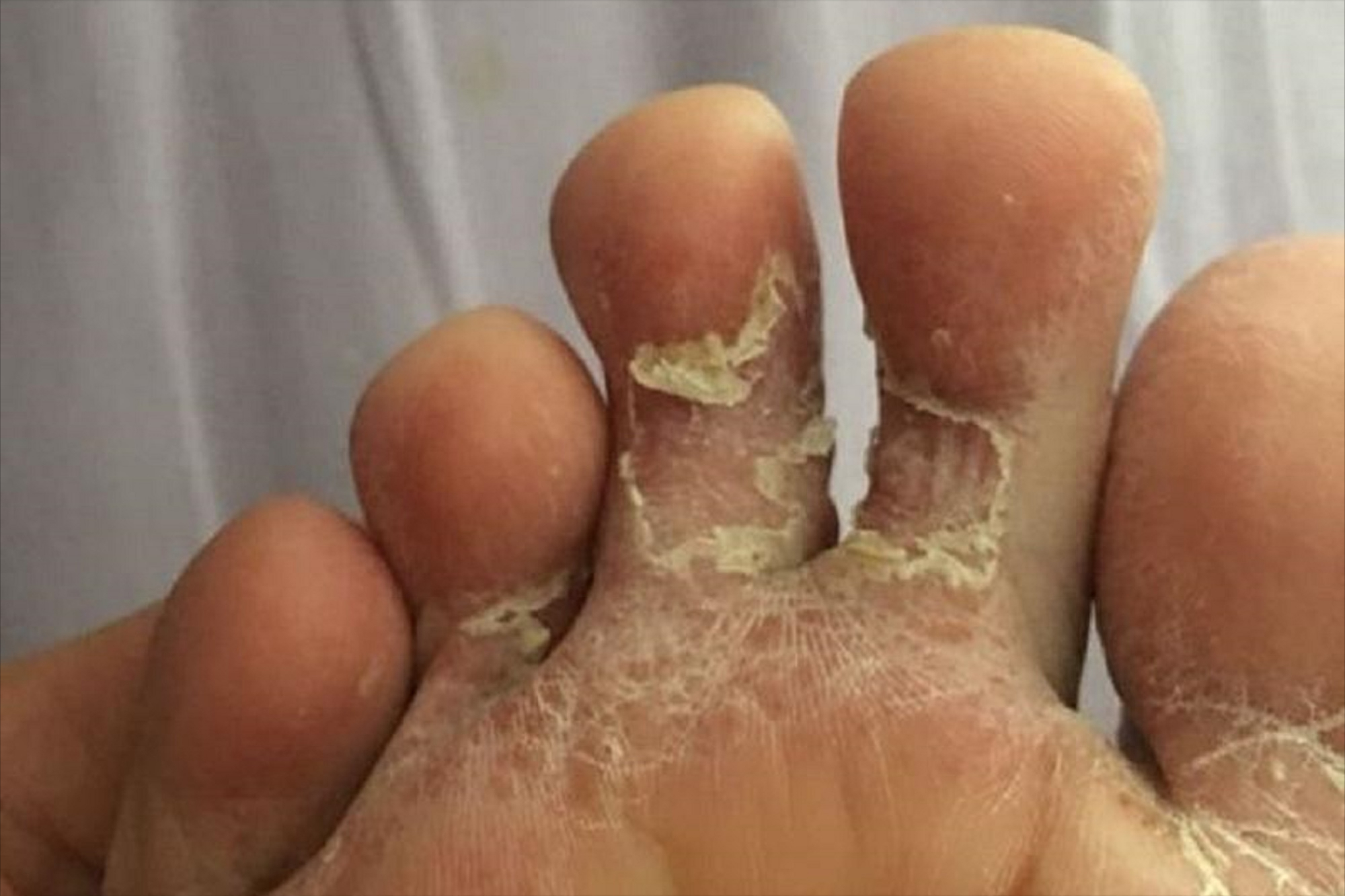 脚气脱皮痒真没治?