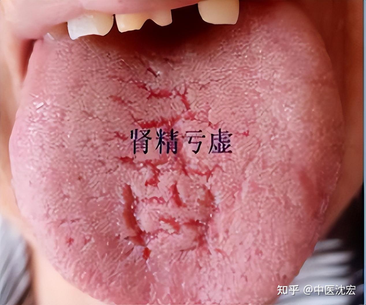 肾虚的人,常见这4种舌苔,看你属于哪一种? - 知乎