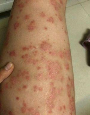 关注问题 67 写回答 登录/注册 牛皮癣 皮肤病 癣 胳膊上长皮藓的