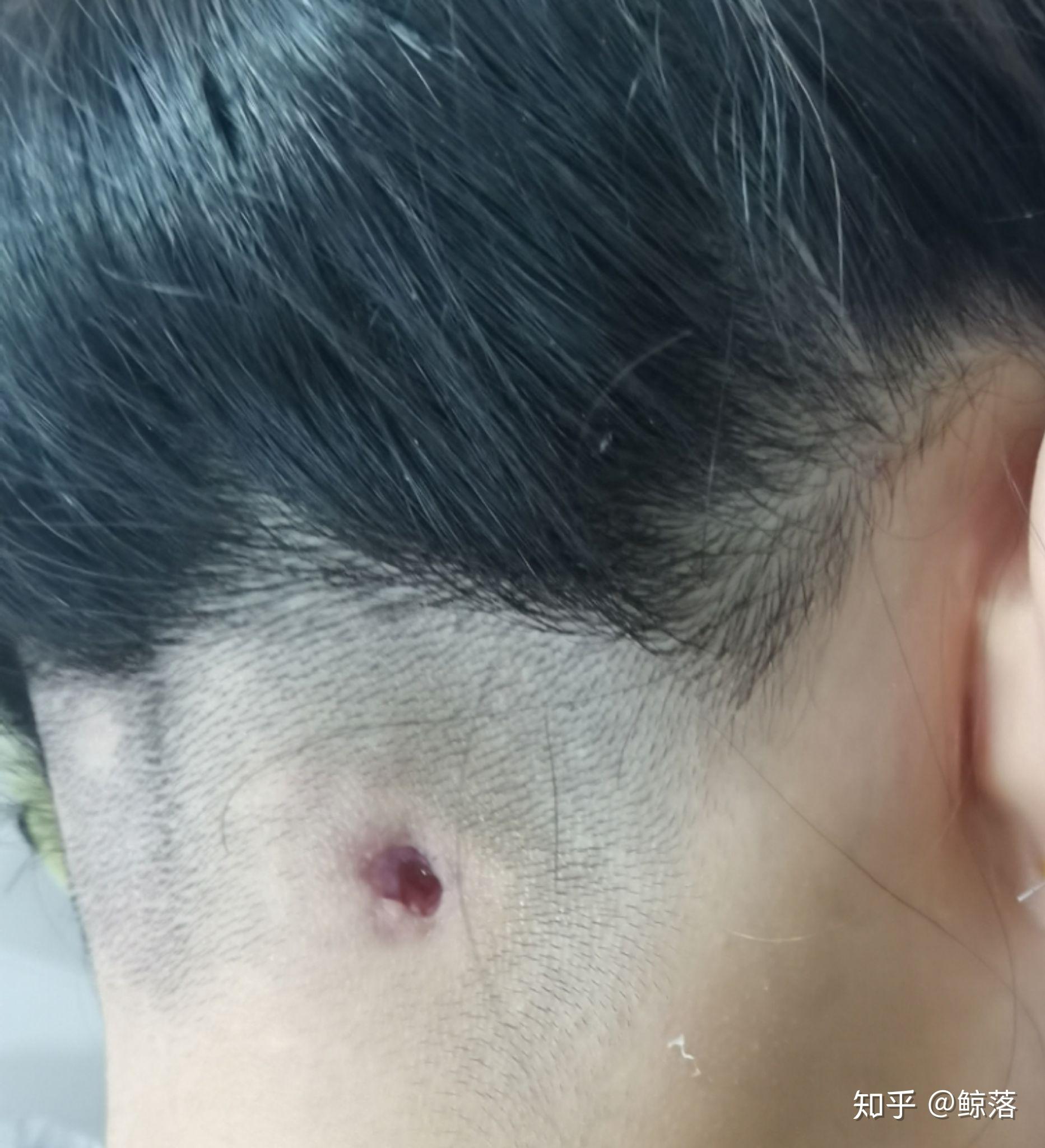 头皮上老是长痘痘,扣了是个血痂要不然就是按着疼的包,这是啥玩意啊?