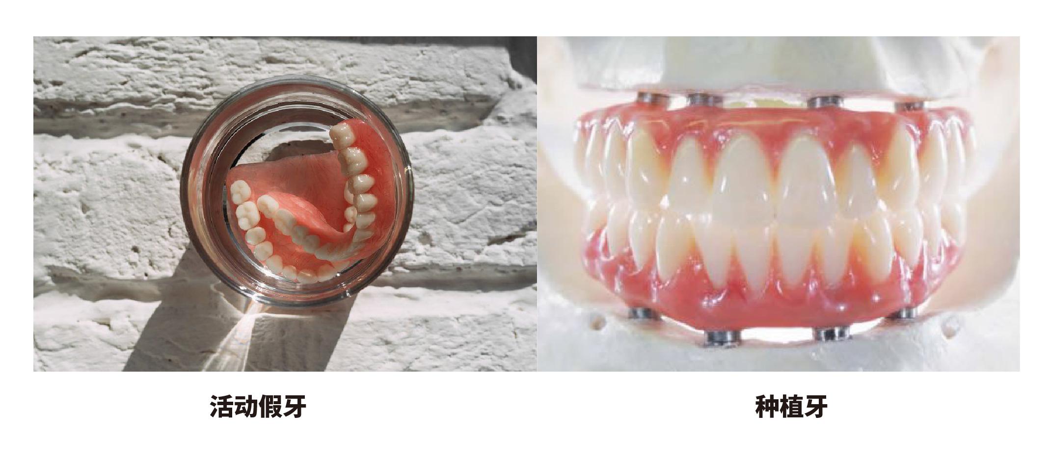 活動假牙v.s固定式假牙