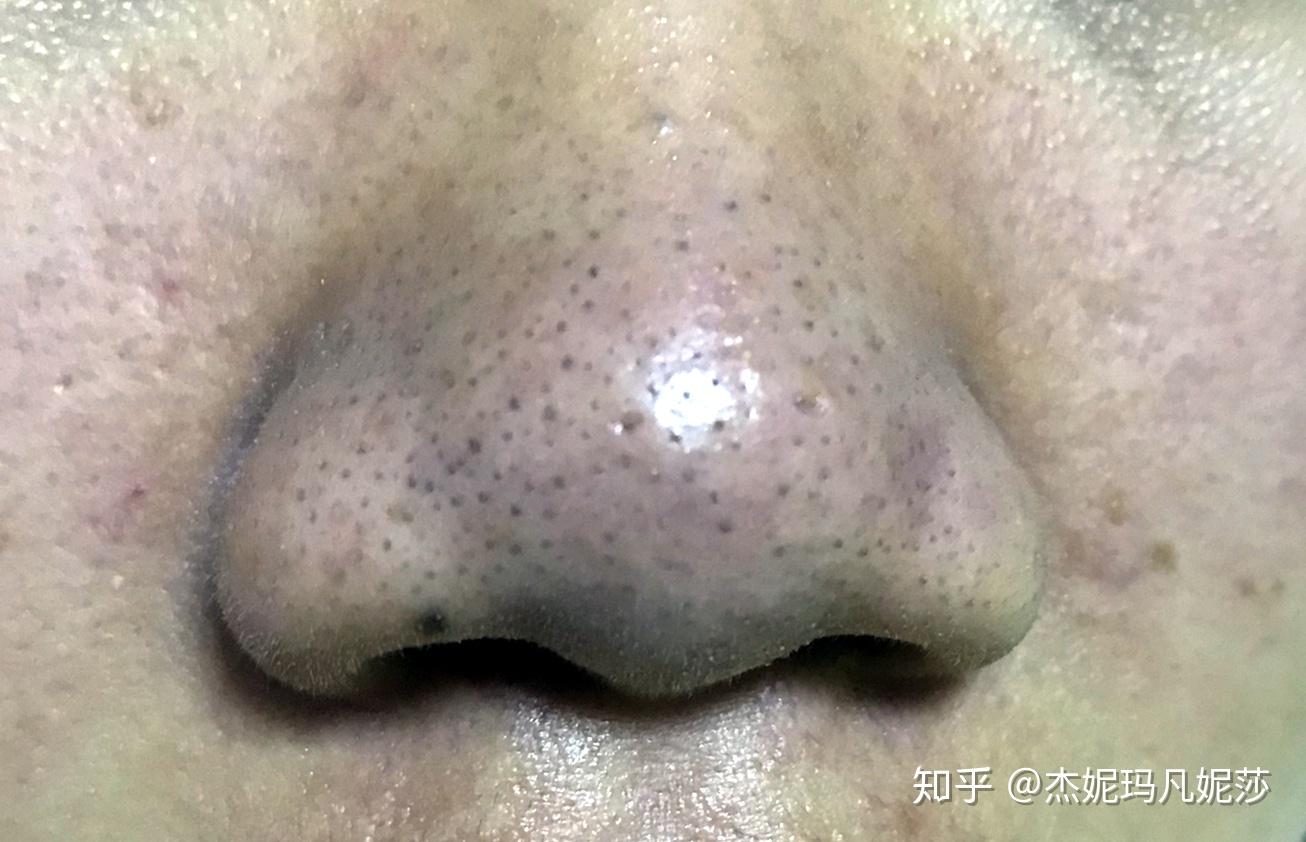 这种黑头请问怎么去? - 知乎