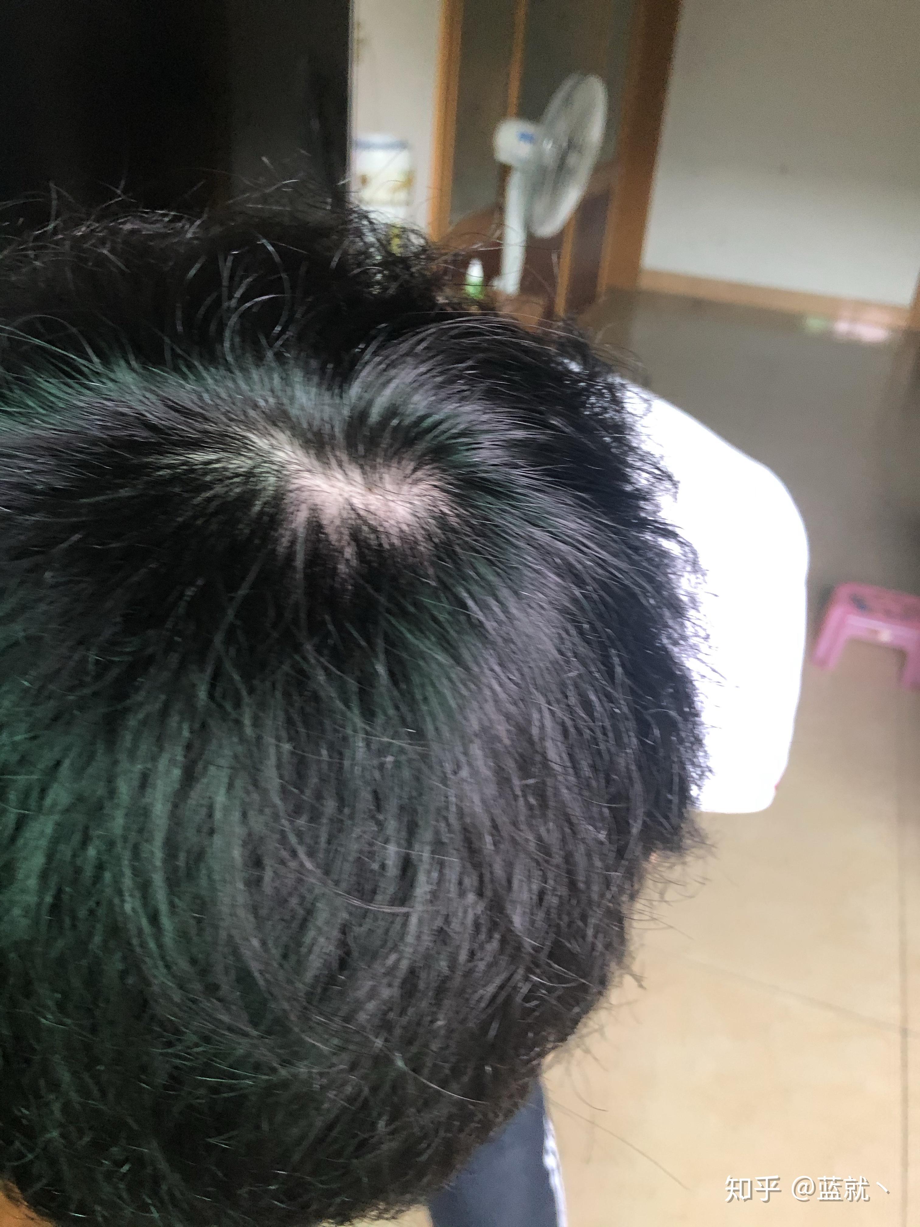 什么样子的发旋是正常的啊？ - 知乎