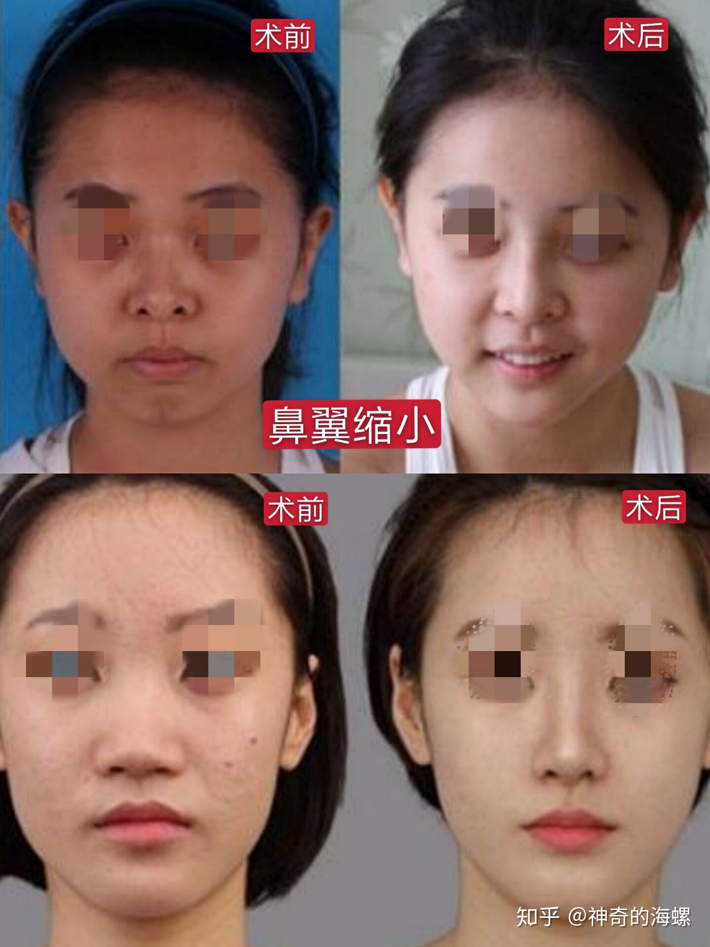 鼻翼缩小手术,是不是失败了? - 知乎