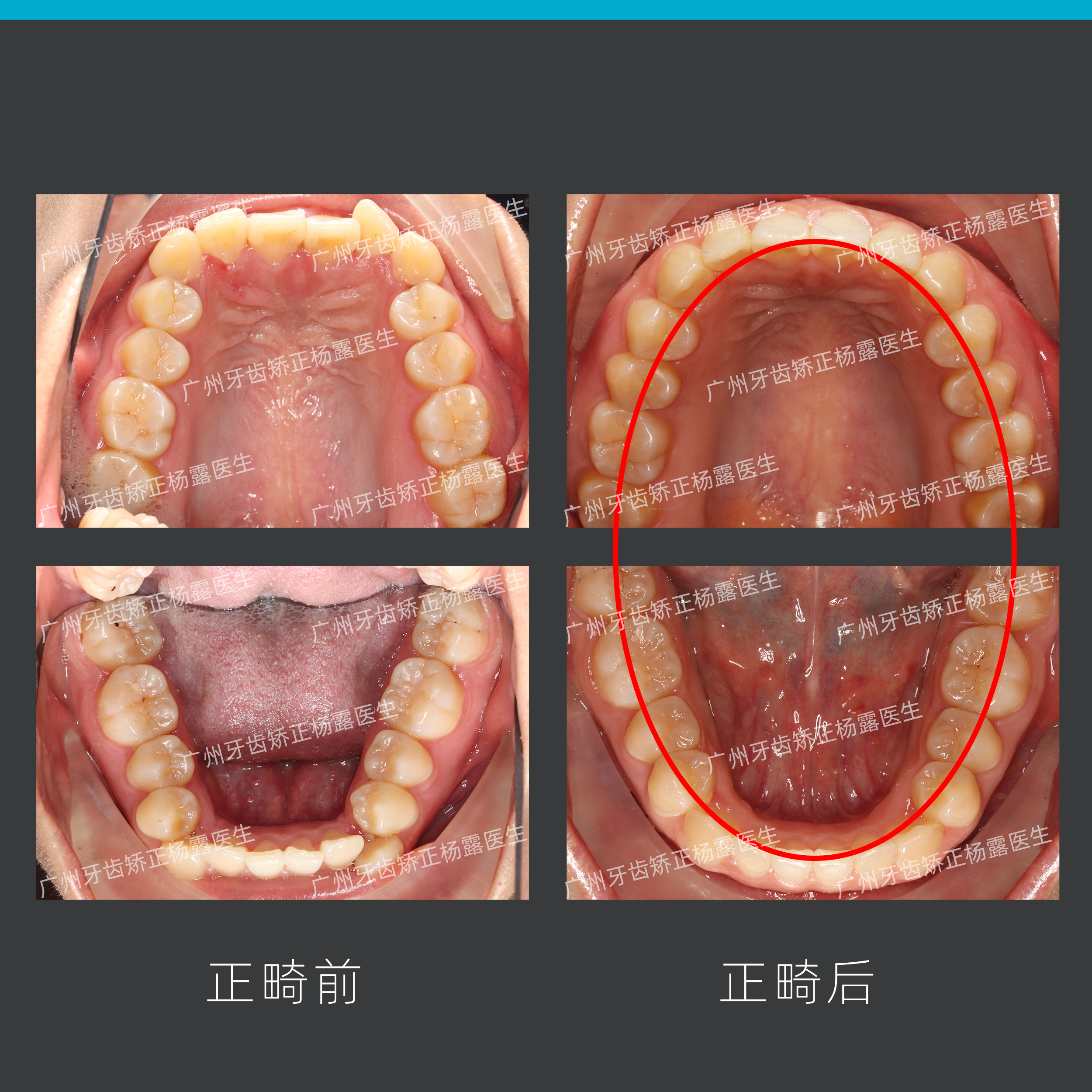 牙弓窄什么脸型图片