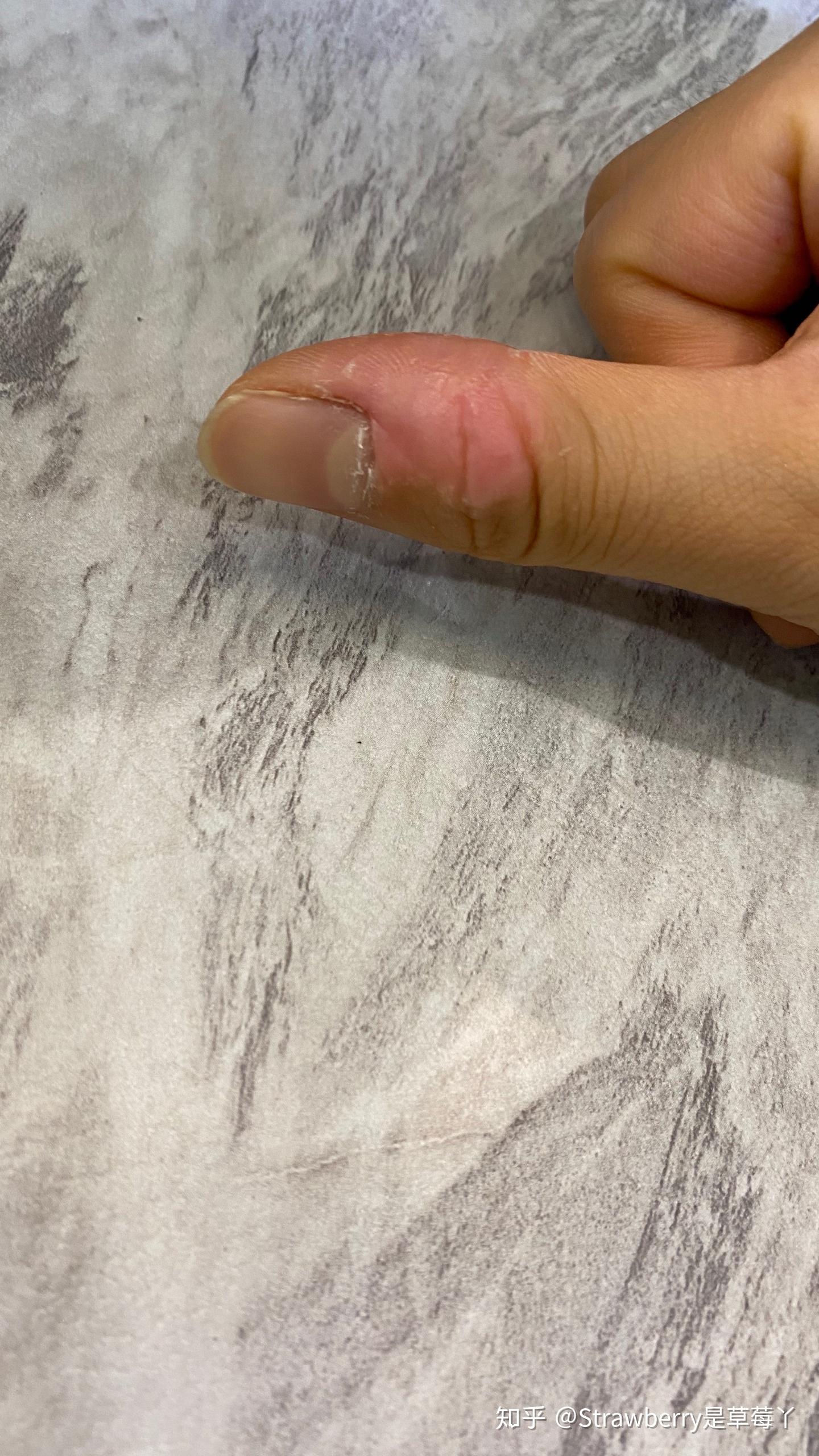 手指头指甲周围死皮不痛不痒泡水发白请问是什么病