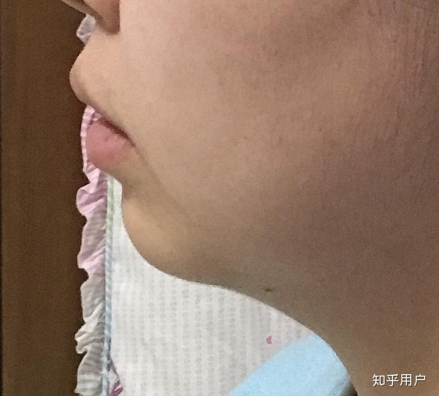 22岁下巴短几乎无下巴怎么办