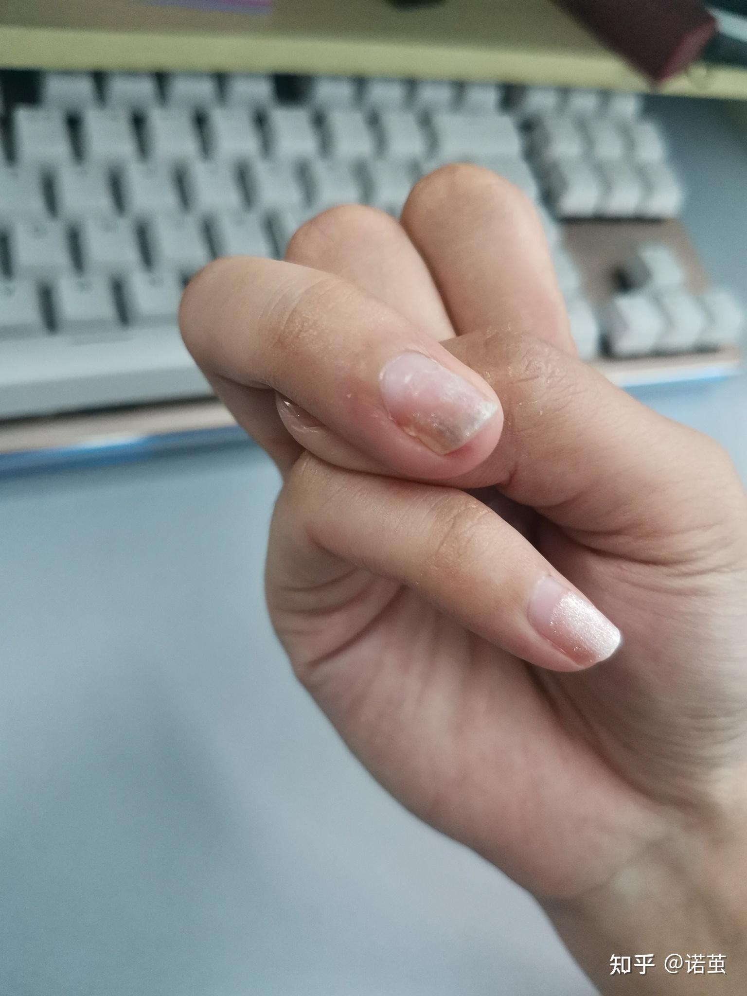 指甲盖被掀开三分之一是什么样的体验? - 知乎