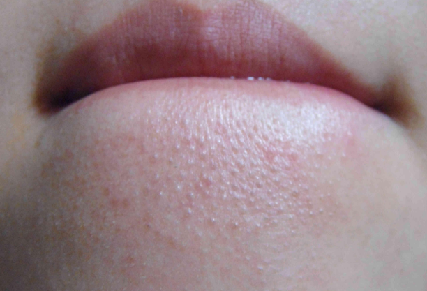 下巴上好多闭口咋搞啊