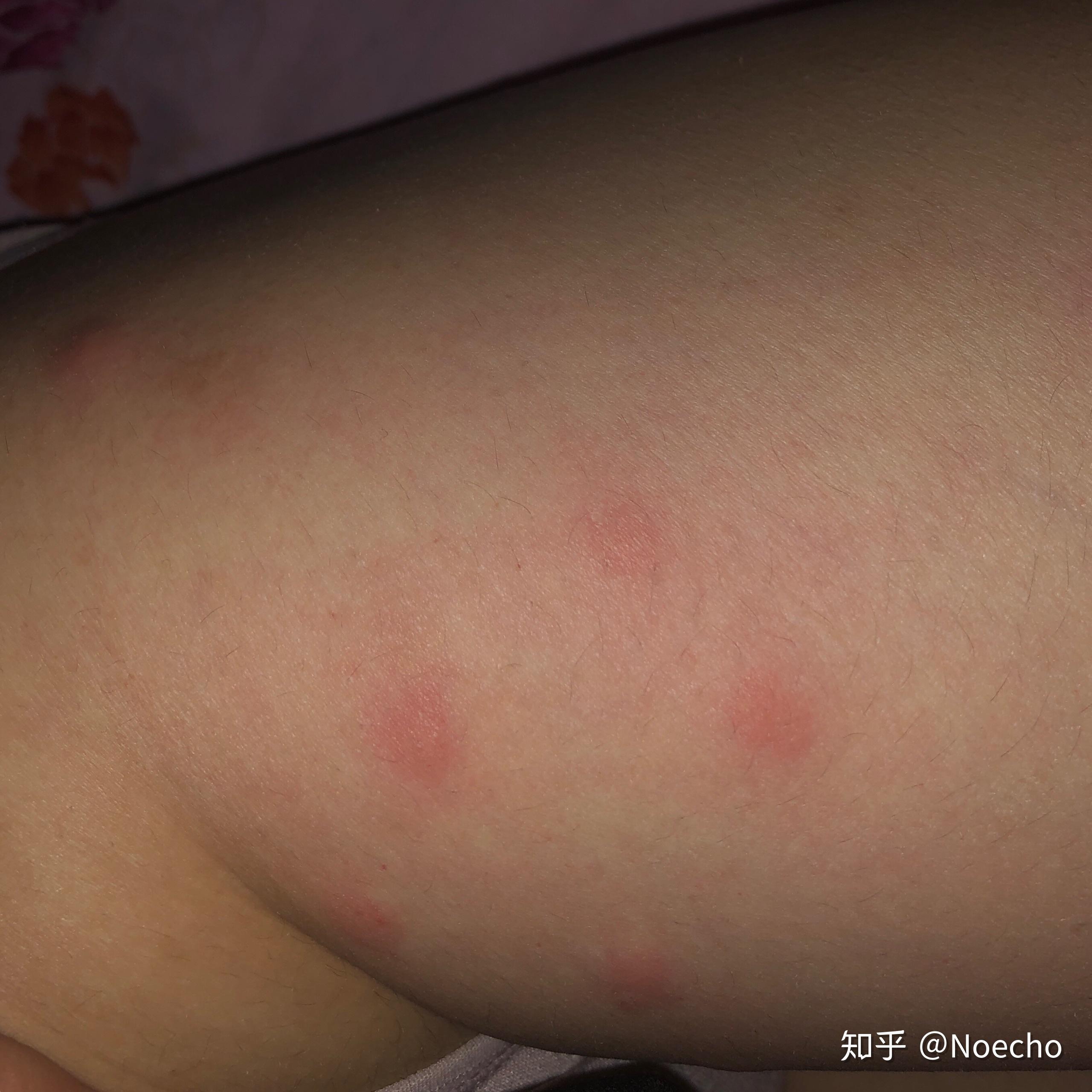 这两天身上会莫名其妙的起小包,就跟蚊子咬的那样痒,床单被罩也都换了