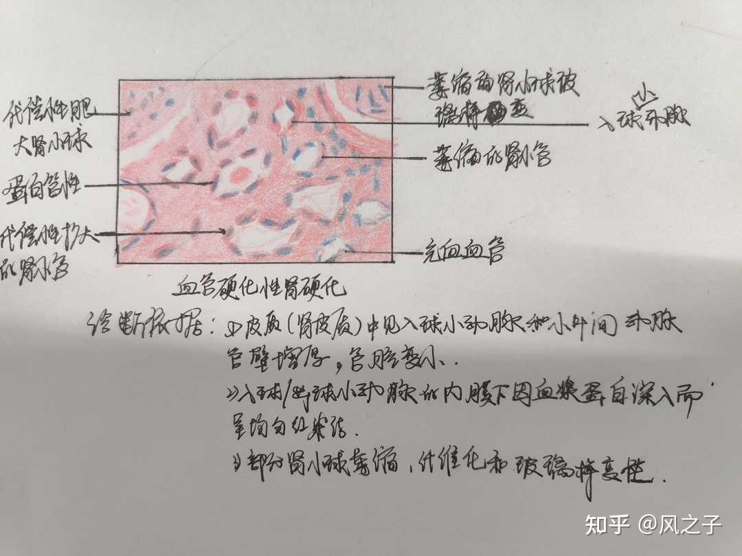 绘制风湿性心肌炎，血管硬化性肾硬化病理切片图，标明病变并说明诊断依据 - 知乎
